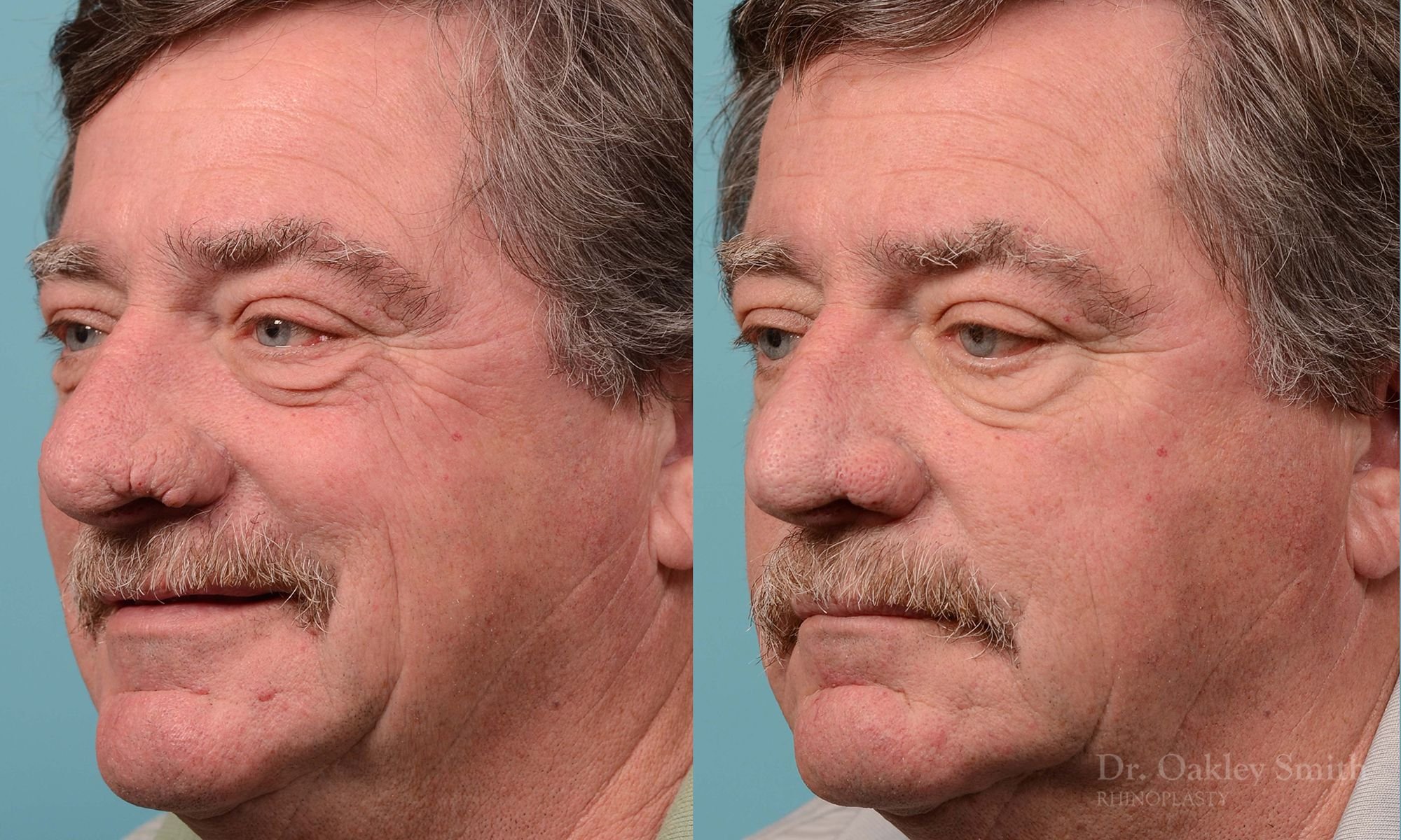Case 210, Dr. Oakley Smith, rhinophyma, 12 months after surgery, left oblique view