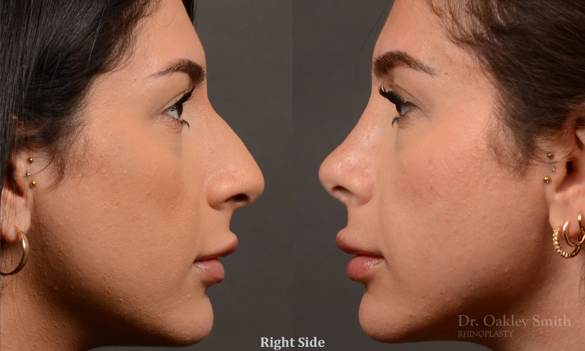 540: Female, Primary Rhinoplasty, Normal Skin, Bridge Work, Tip Work