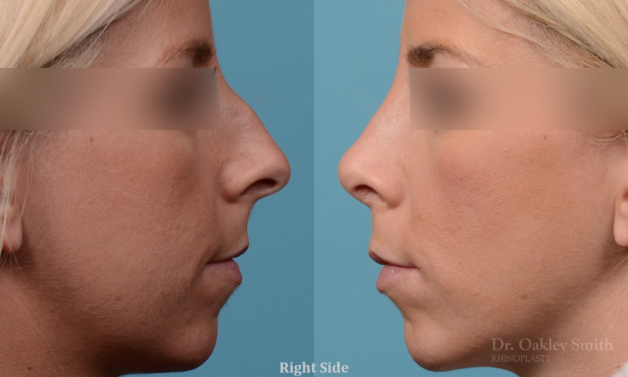 242C-rhinoplasty-dr-oakley-smith-toronto-nose-job-2.jpg