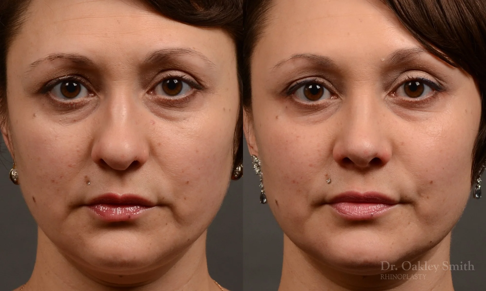 505A-rhinoplasty-dr-oakley-smith-toronto-top-surgeon-nose-job.jpg