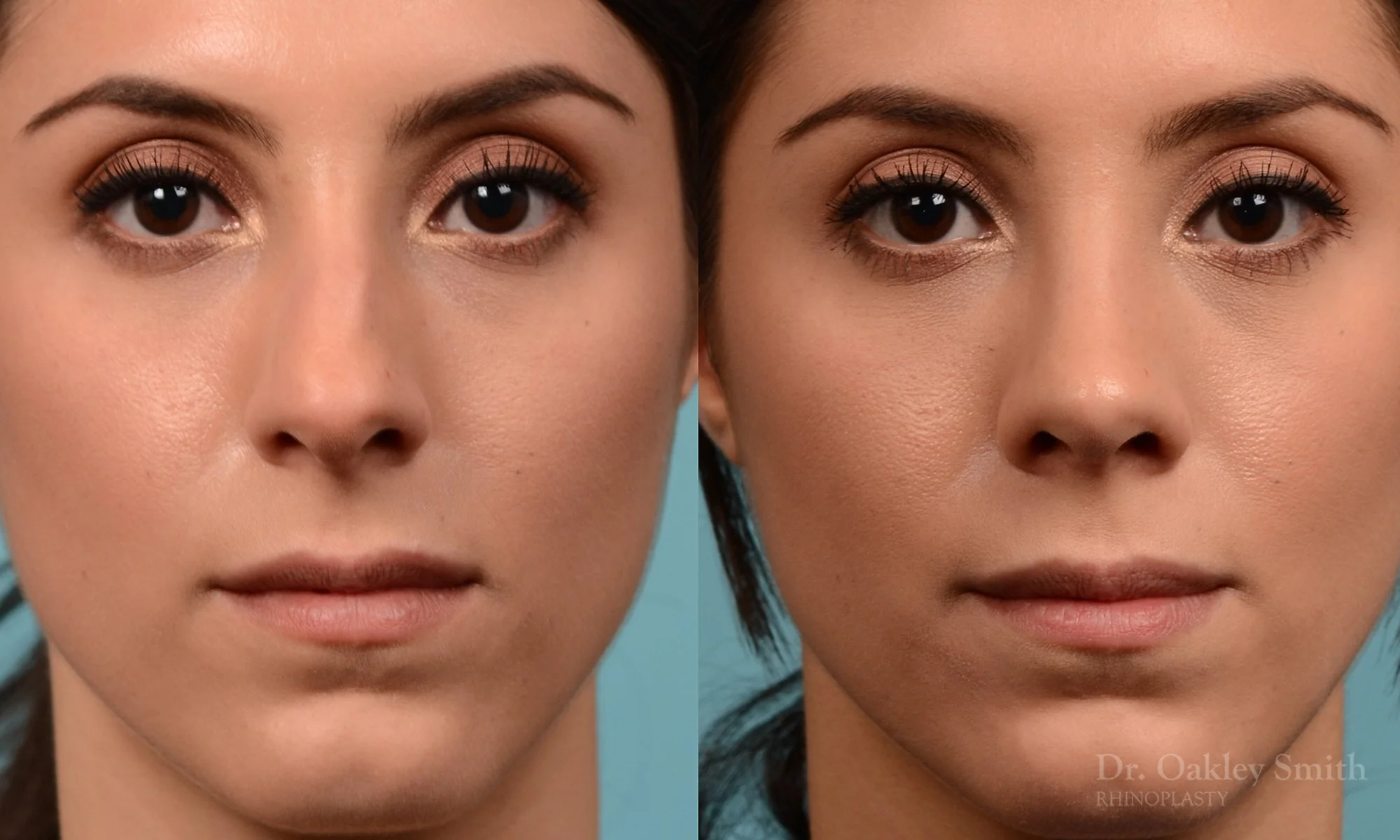 229A-rhinoplasty-oakley-smith-toronto-nose-job-straight-nose-bridge-1.jpg