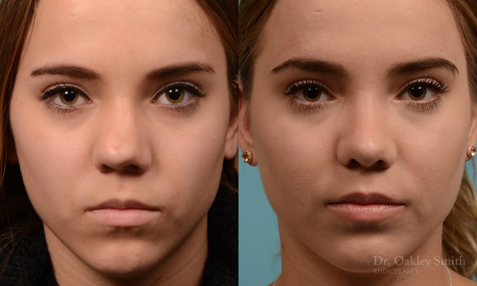 355A-rhinoplasty-dr-oakley-smith-toronto-nose-job.jpg