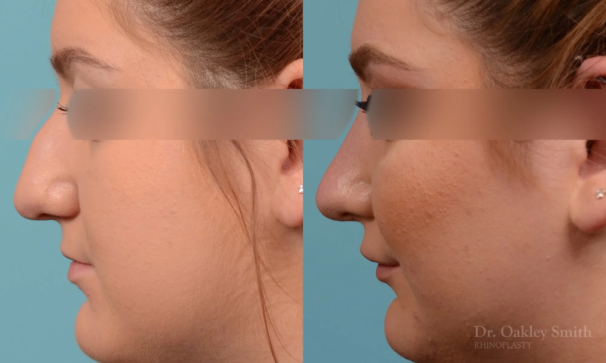 235E-watermark-curved-nose-nose-job-dr-oakley-smith-toronto-rhinoplasty-bump-on-bridge.jpg