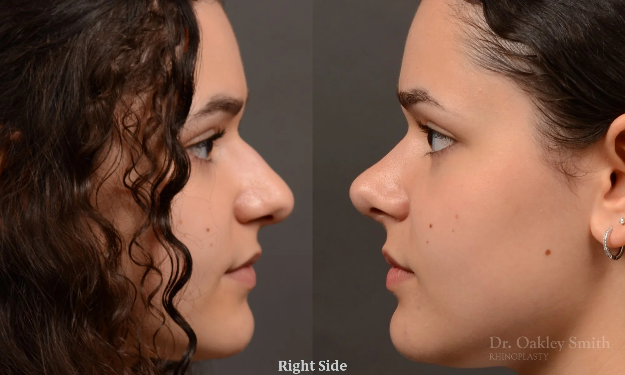 543: Female, Ethnic Rhinoplasty, Thick Skin, Dorsal Bump, Bulbous Tip Refinement