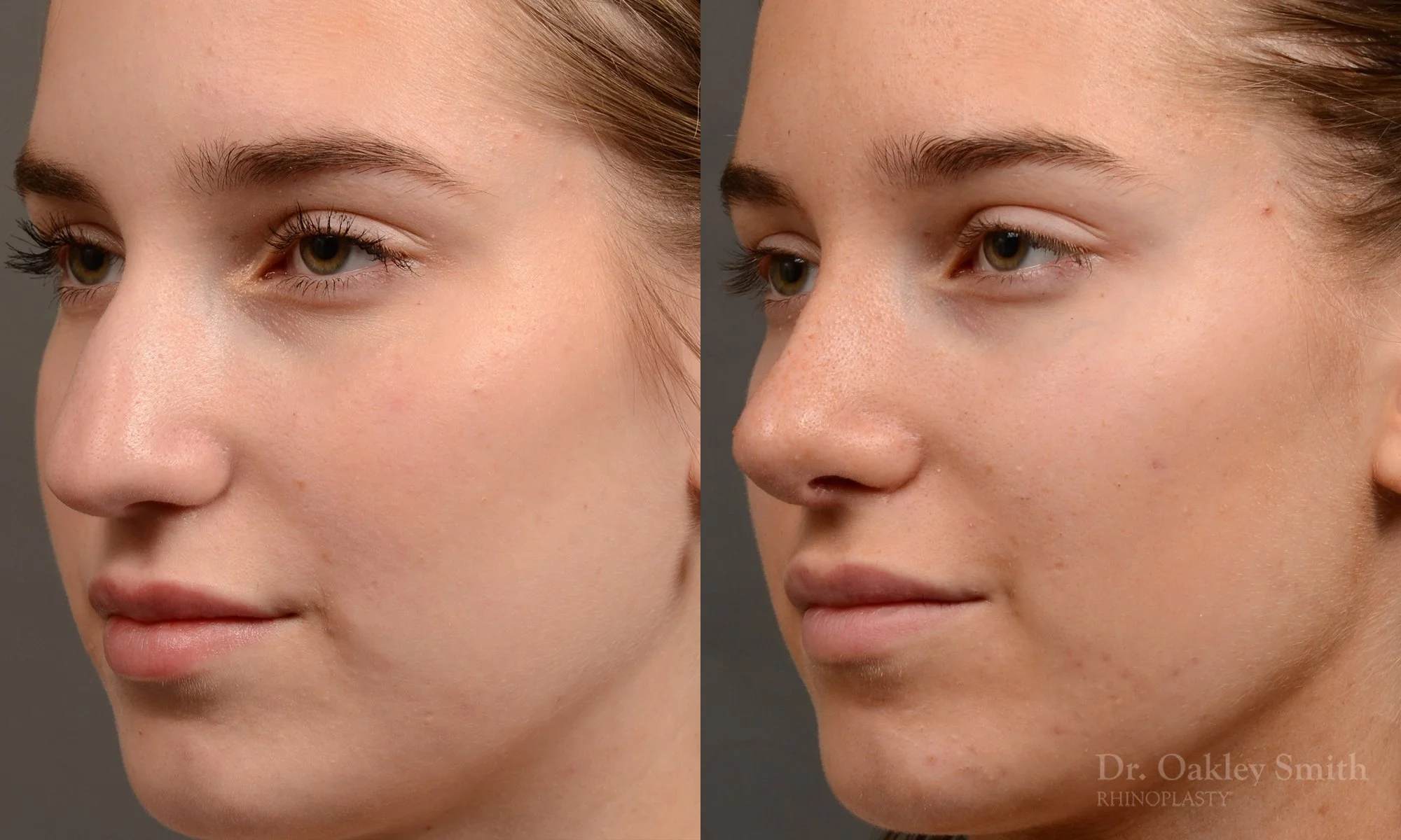 537D-rhinoplasty-before-after-top-toronto-nose-surgeon.jpg