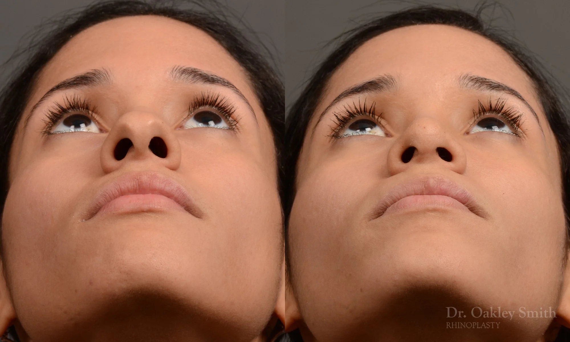 330F-rhinoplasty-dr-oakley-smith-toronto-nose-job.jpg