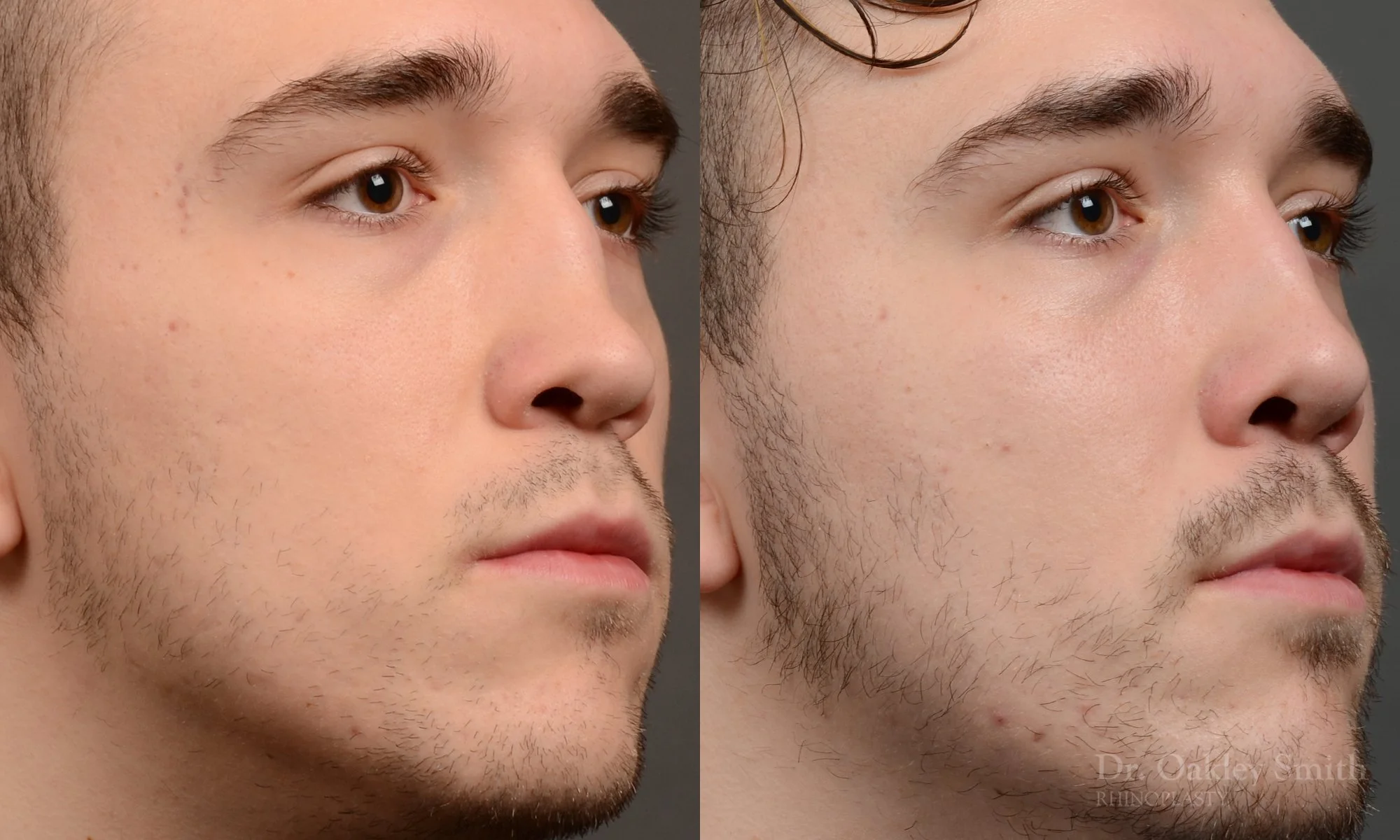 503B-male-rhinoplasty-dr-oakley-smith-toronto-top-surgeon-nose-job.jpg