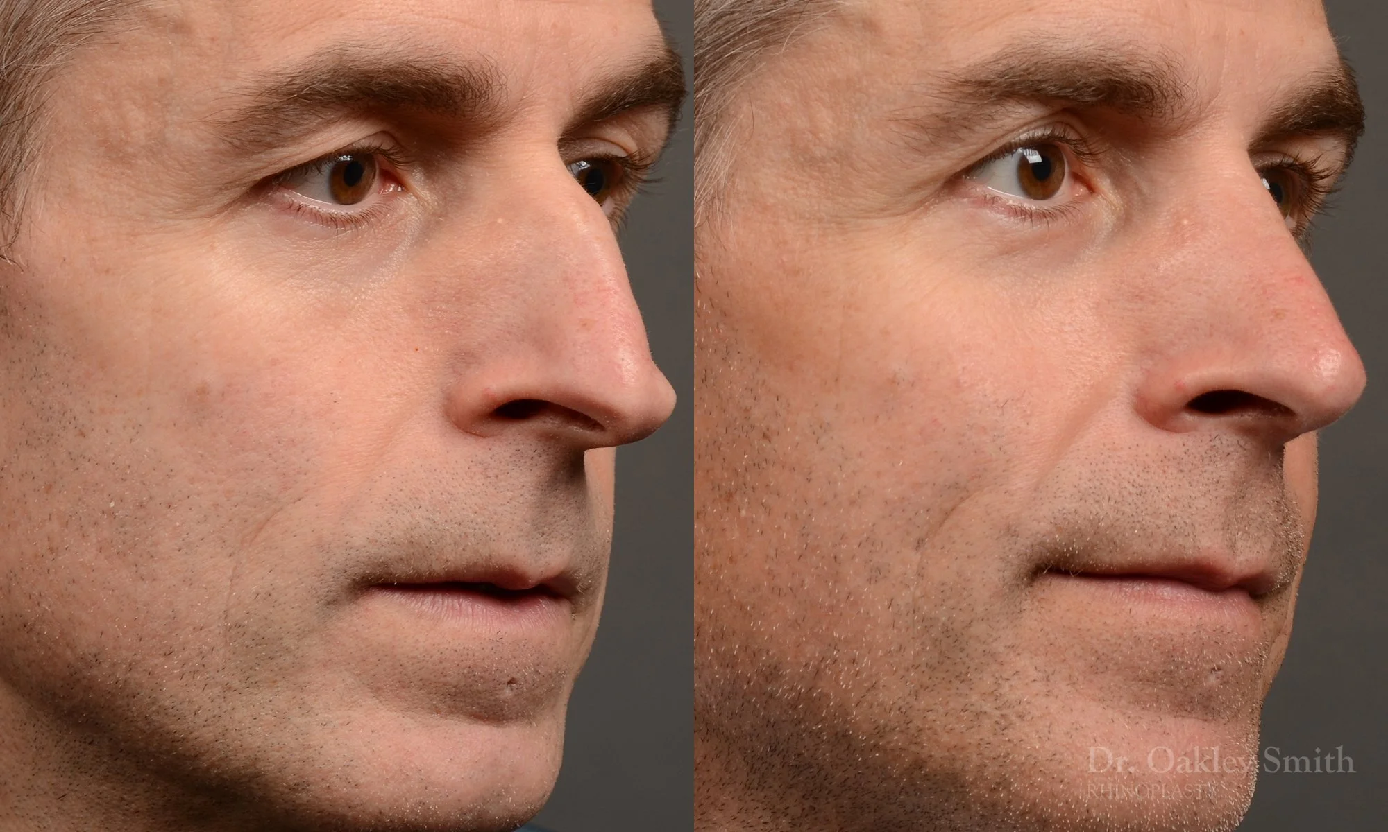 535B-male-rhinoplasty-dr-oakley-smith-toronto-top-surgeon-nose-job.jpg