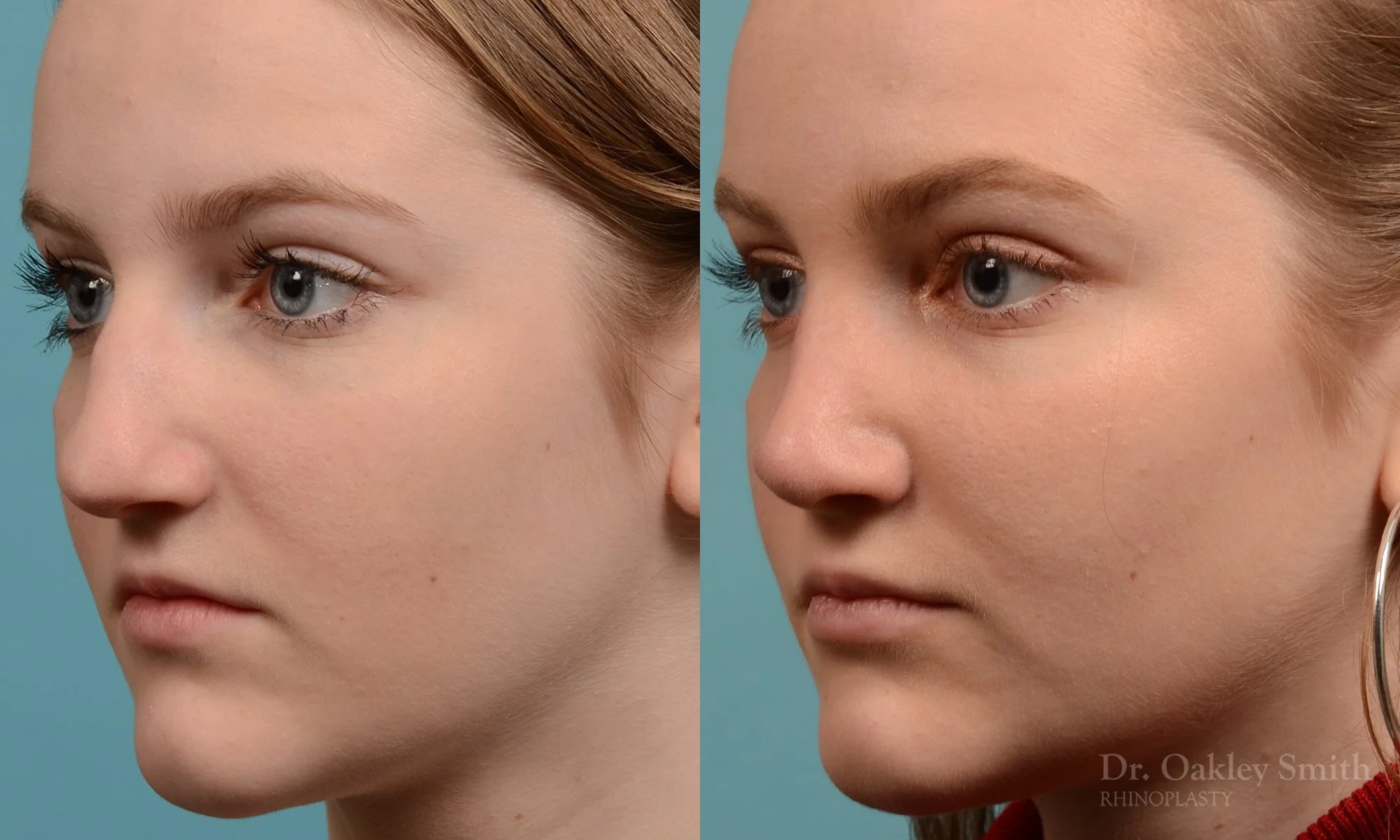 314D-rhinoplasty-dr-oakley-smith-toronto-nose-job.jpg