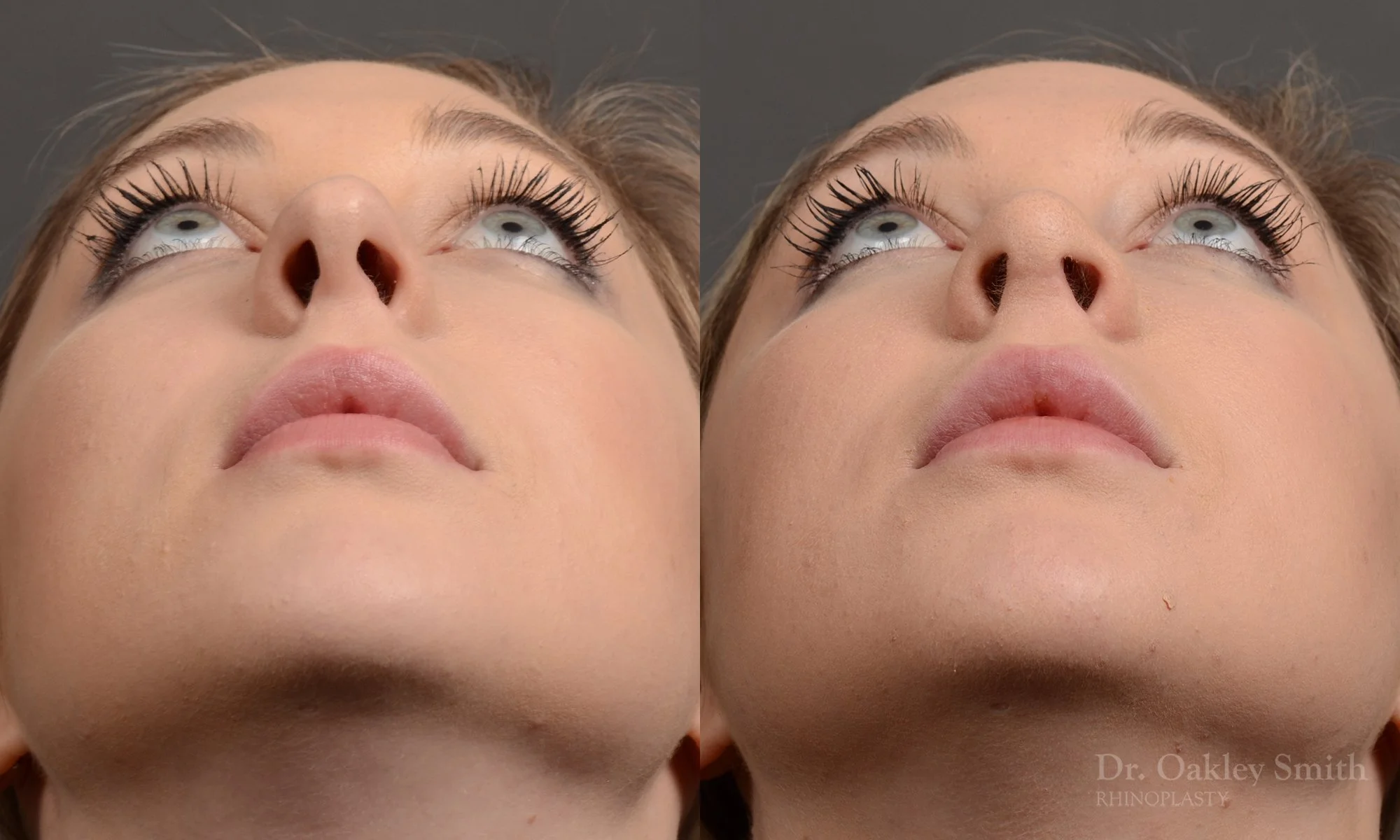 348F-rhinoplasty-dr-oakley-smith-toronto-nose-job.jpg