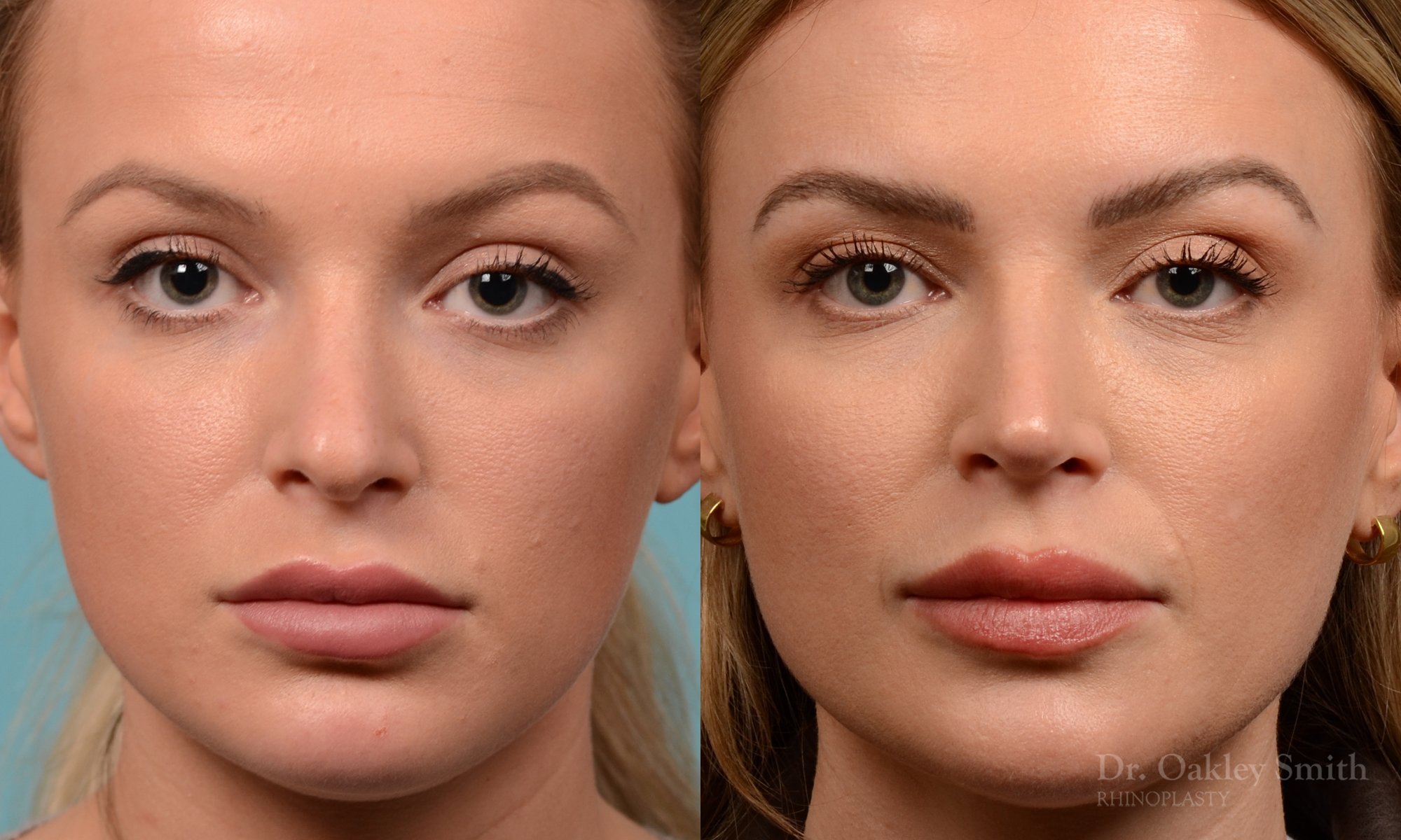 538A-rhinoplasty-dr-oakley-smith-toronto-nose-job.jpg