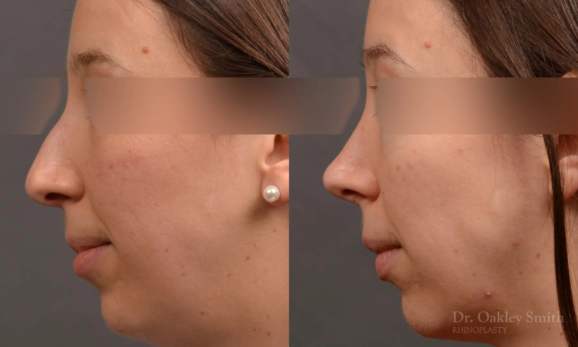 534E-rhinoplasty-dr-oakley-smith-toronto-top-surgeon-nose-job.jpg