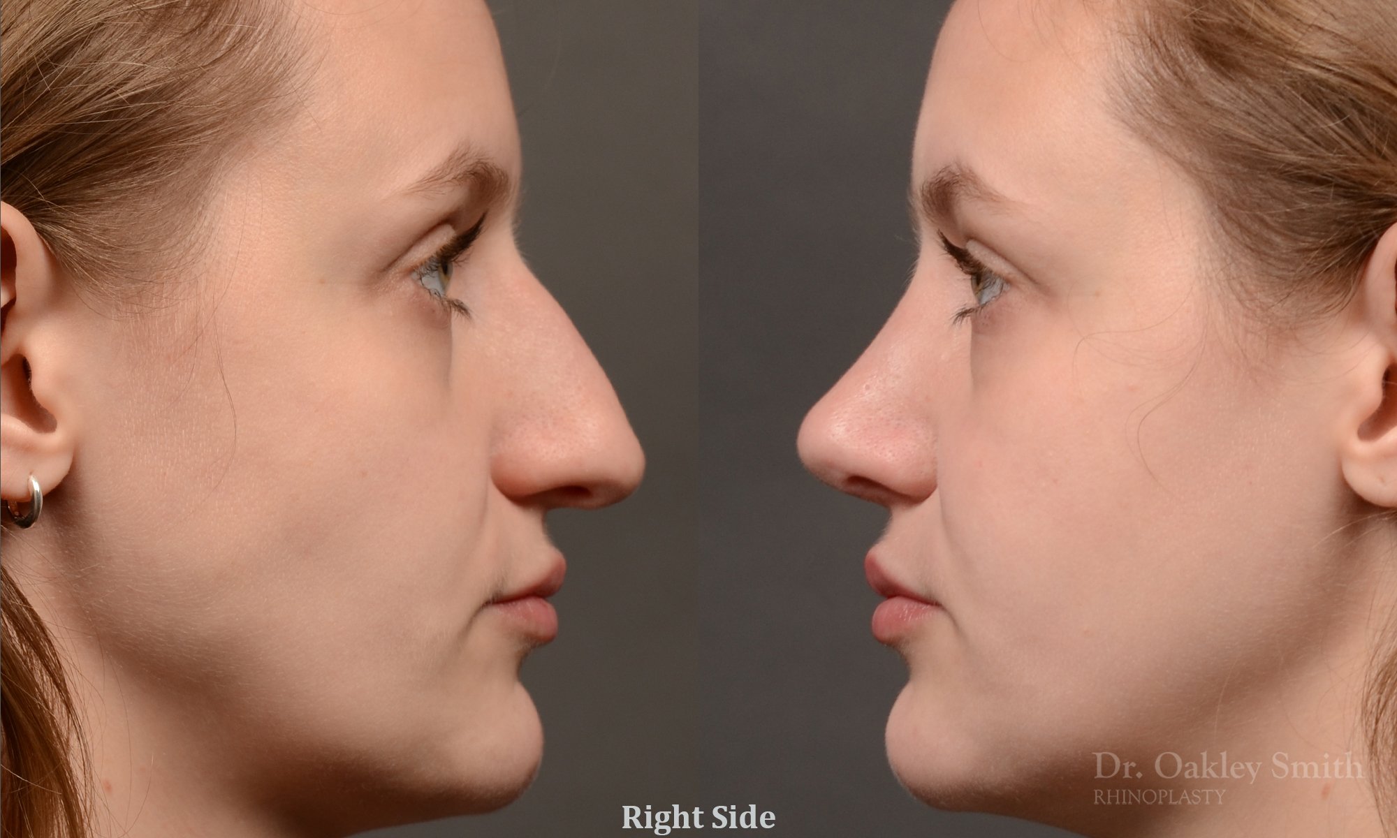 539C-rhinoplasty-dr-oakley-smith-toronto-nose-job.jpg