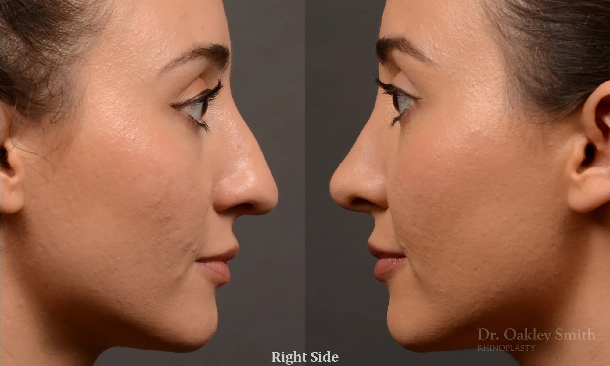 522: Female, Ethnic Rhinoplasty, Dorsal Hump, Tip Refinement
