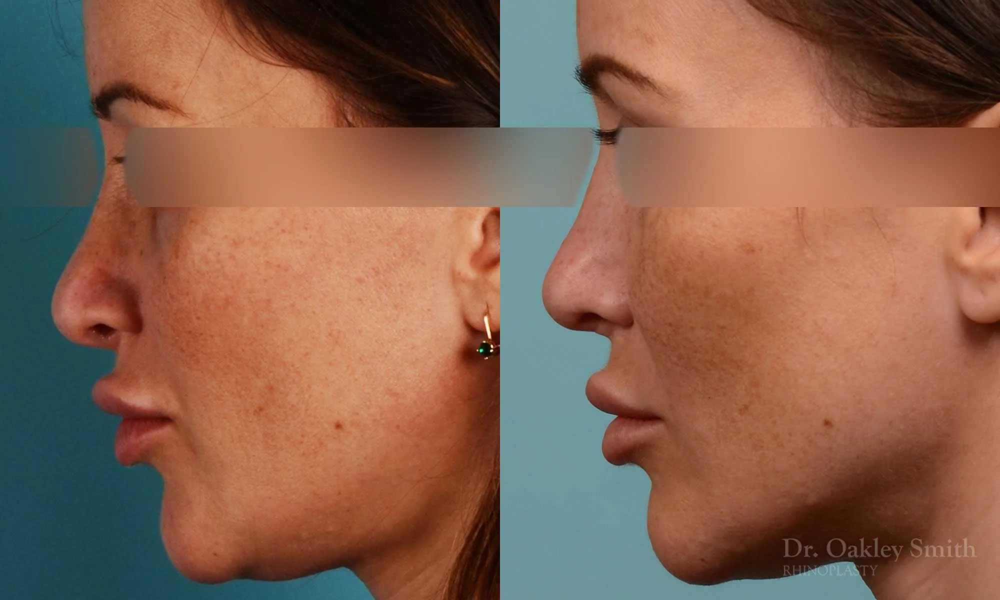 258E-rhinoplasty-dr-oakley-smith-toronto-nose-job.jpg