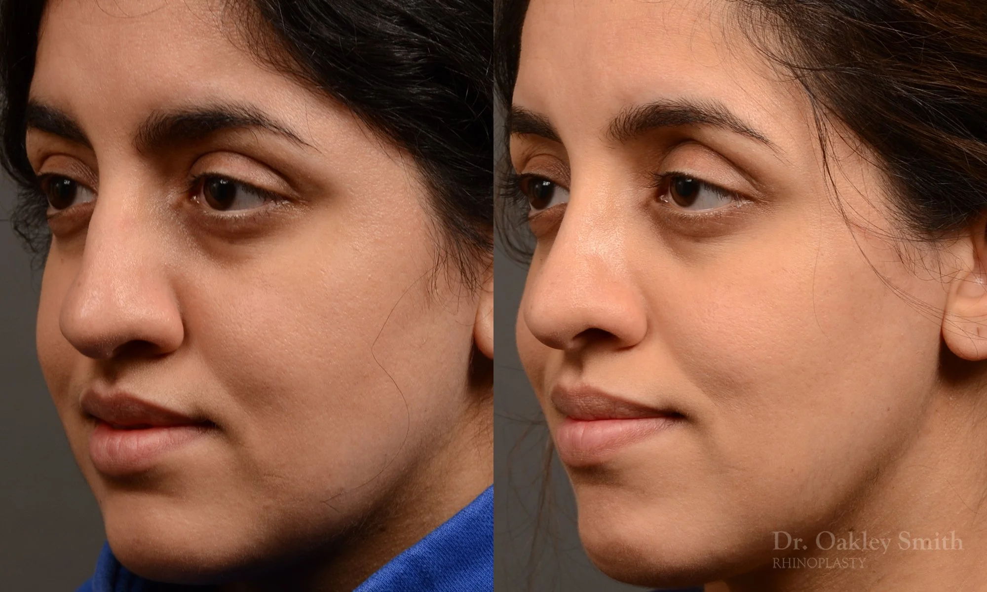 Case 565, Dr Oakley Smith, preservation rhinoplasty, 12 months after surgery, left oblique view
