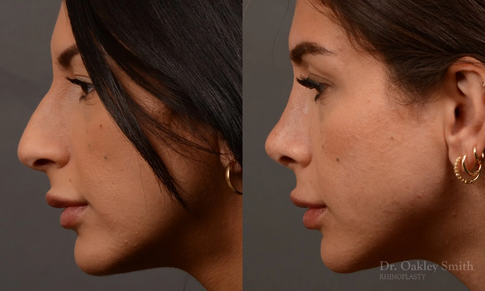540E-rhinoplasty-dr-oakley-smith-toronto-nose-job.jpg