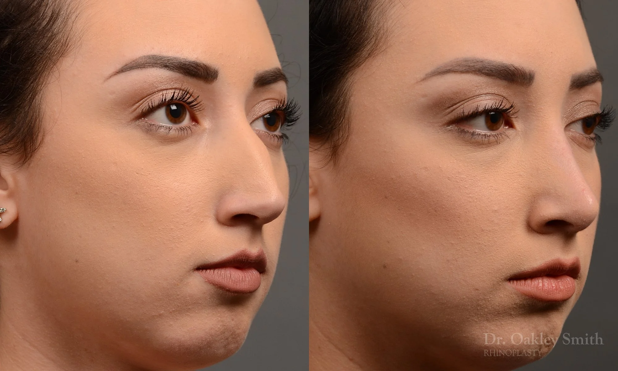 340.1B-rhinoplasty-dr-oakley-smith-toronto-nose-job.jpg