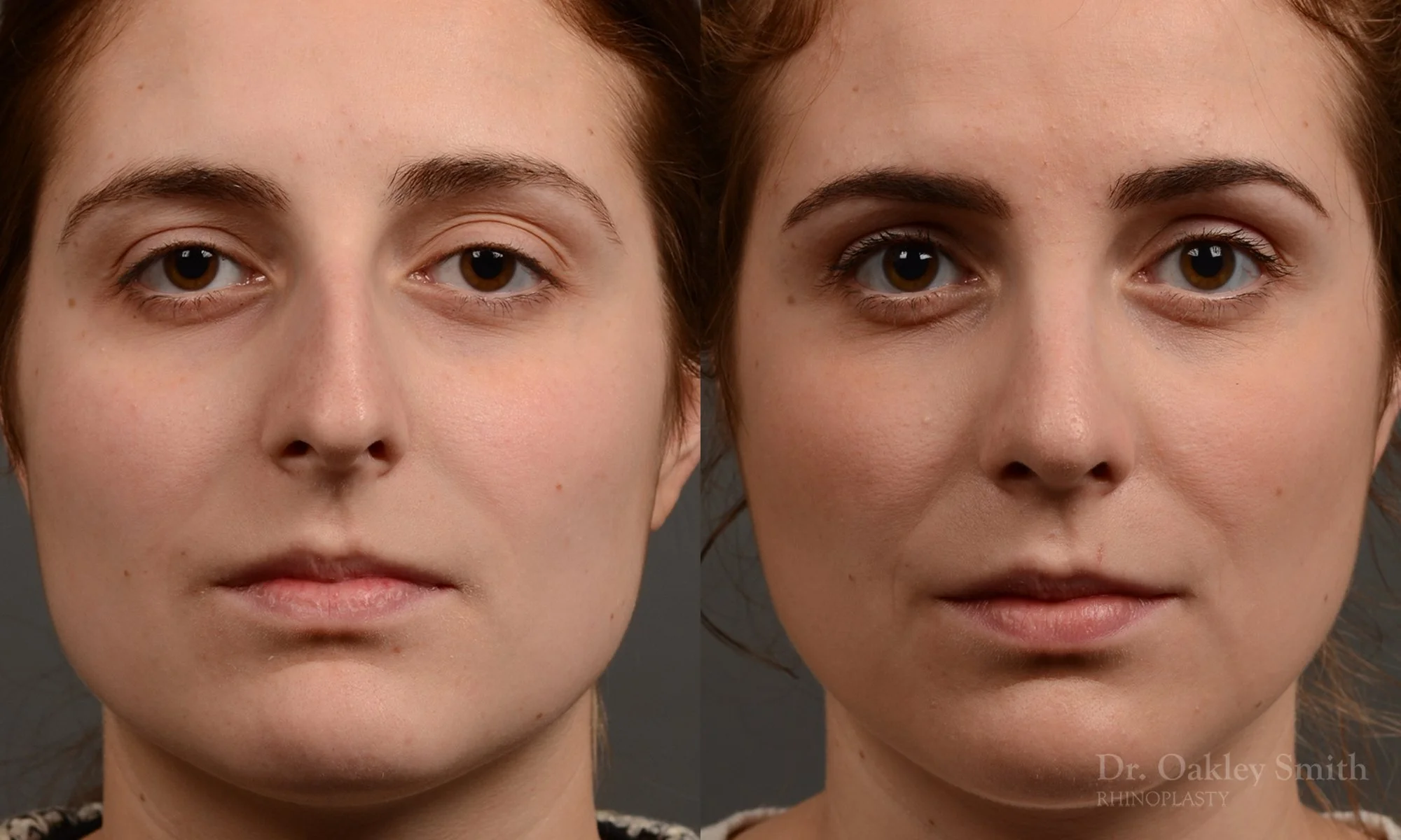 305.1A-rhinoplasty-dr-oakley-smith-toronto-nose-job.jpg