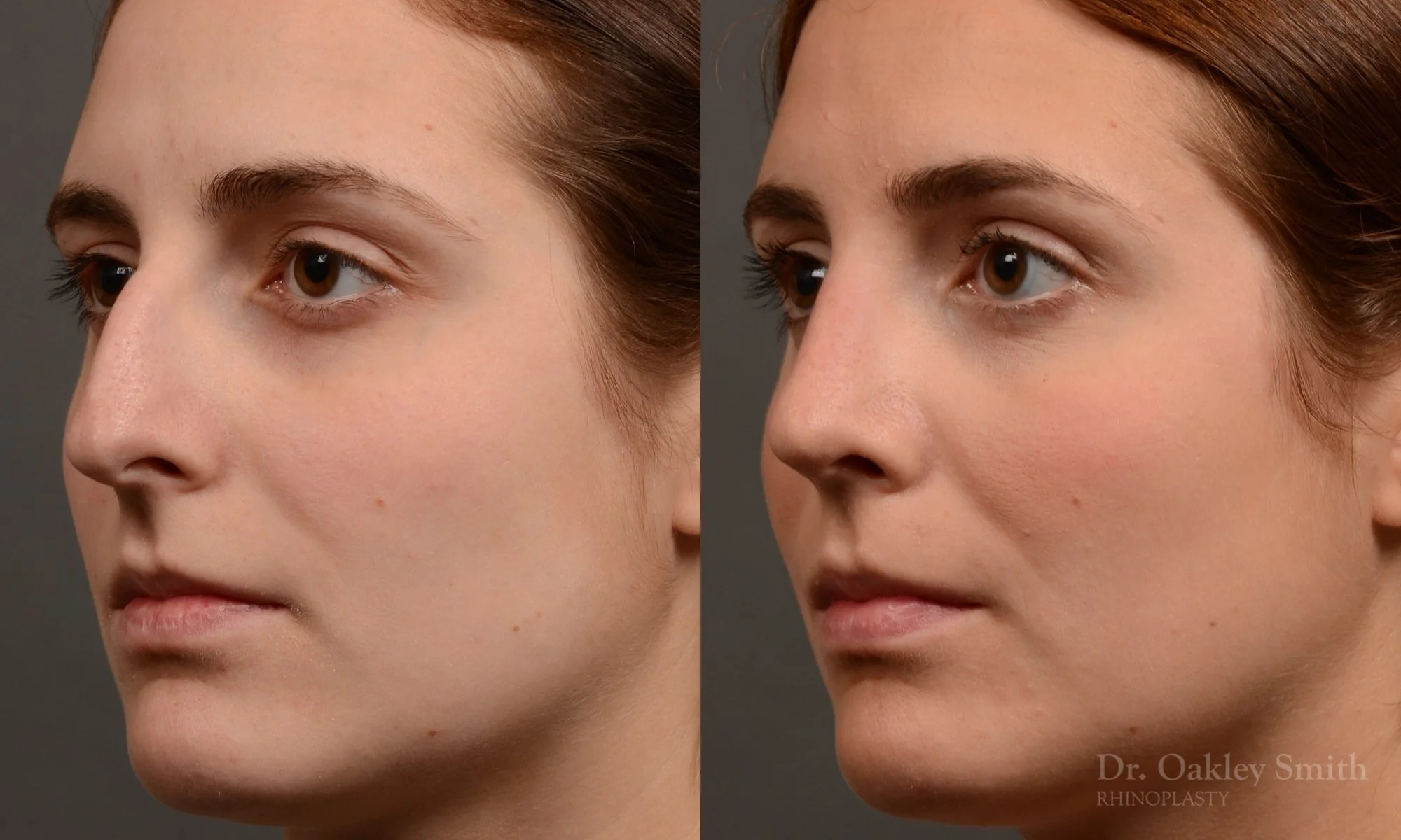 305D-rhinoplasty-dr-oakley-smith-toronto-nose-job.jpg