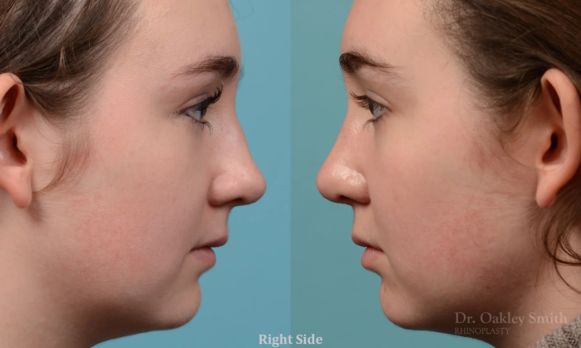 264C-rhinoplasty-dr-oakley-smith-toronto-nose-job.jpg