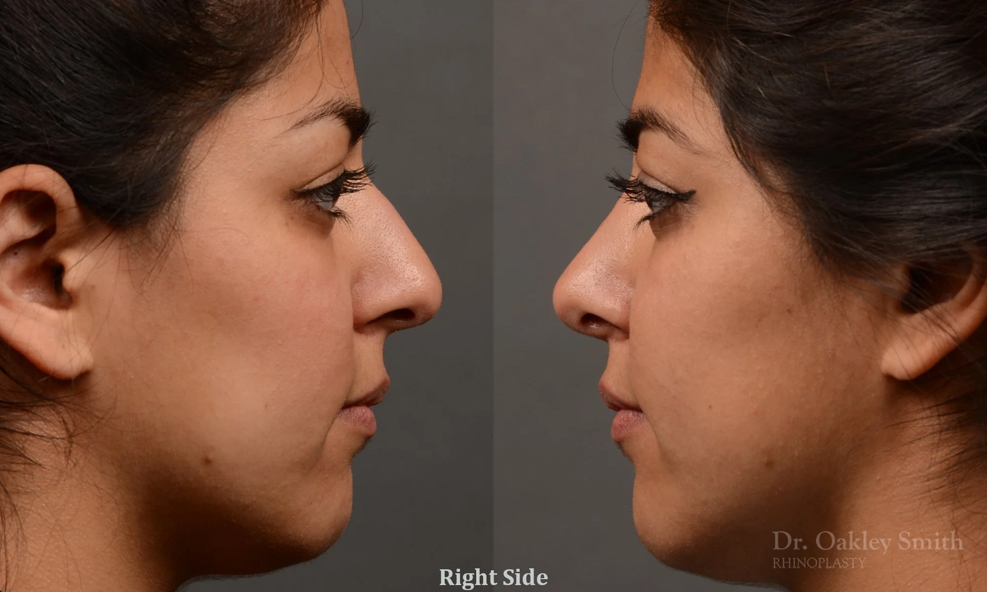 296: Female, Ethnic Rhinoplasty, Thick Skin, Dorsal Hump, Tip Refinement, Crooked