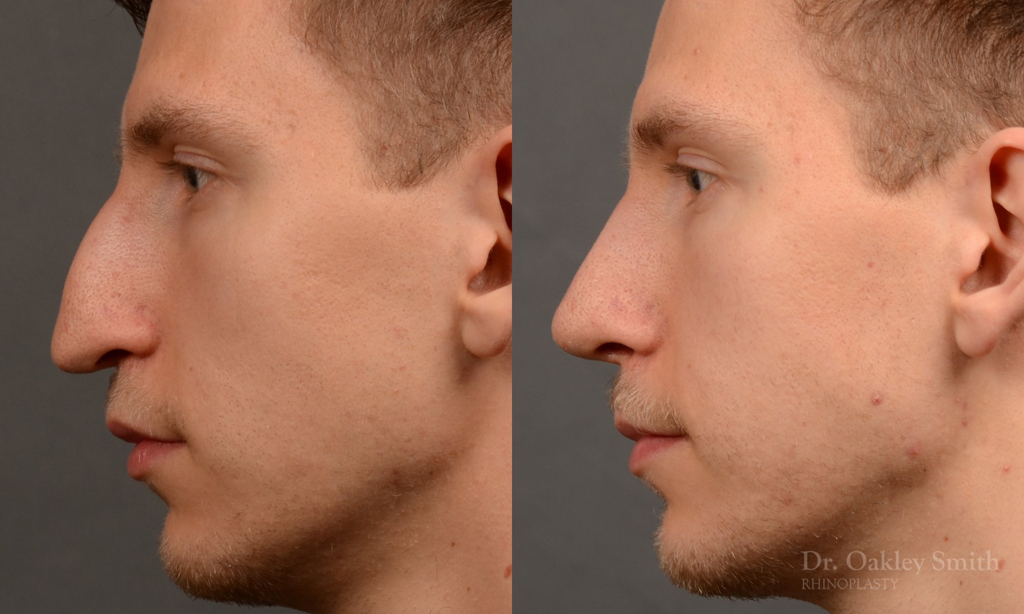 498E-rhinoplasty-dr-oakley-smith-toronto-top-surgeon-nose-job.jpg