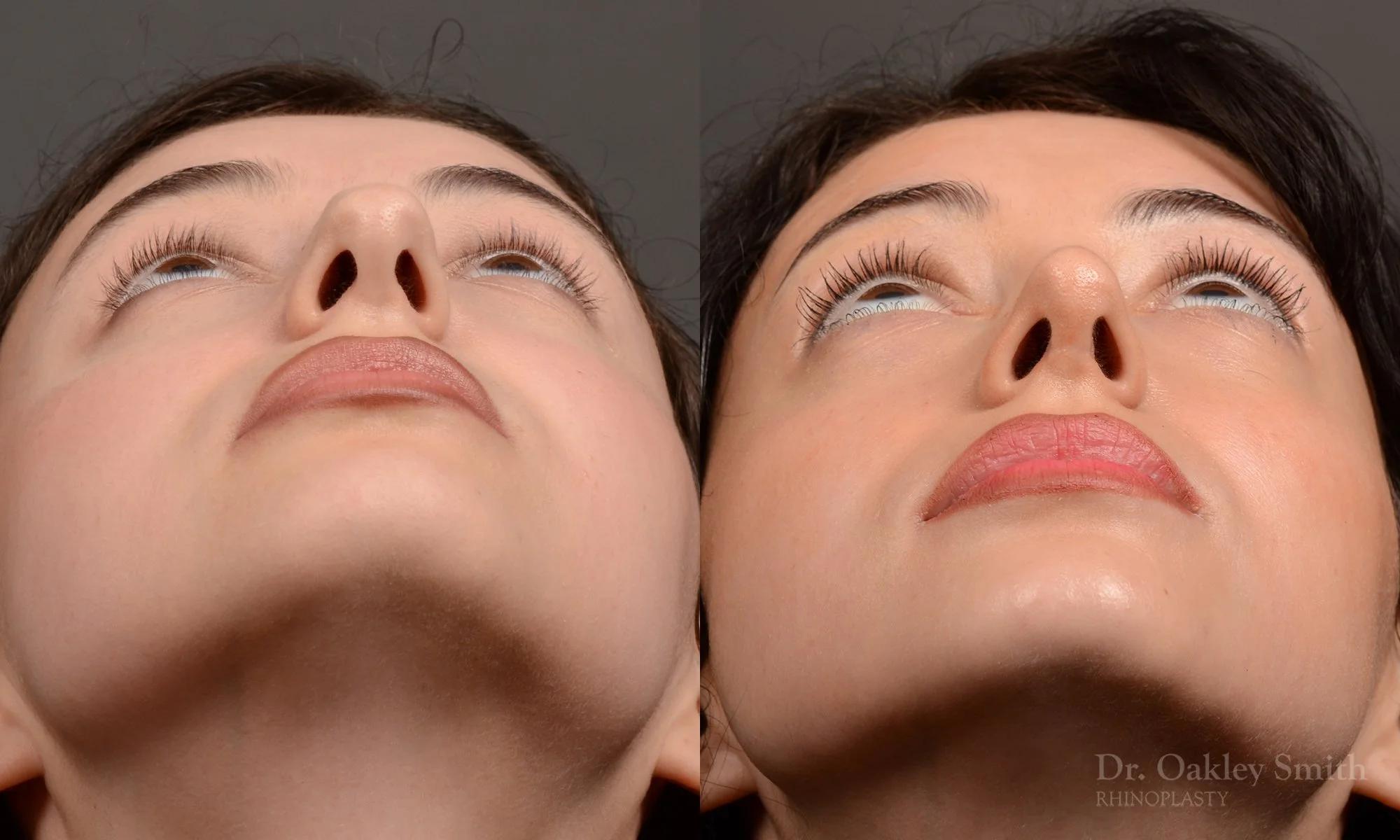 547F-rhinoplasty-dr.-oakley-smith-top-rhino-surgeon-toronto.jpg