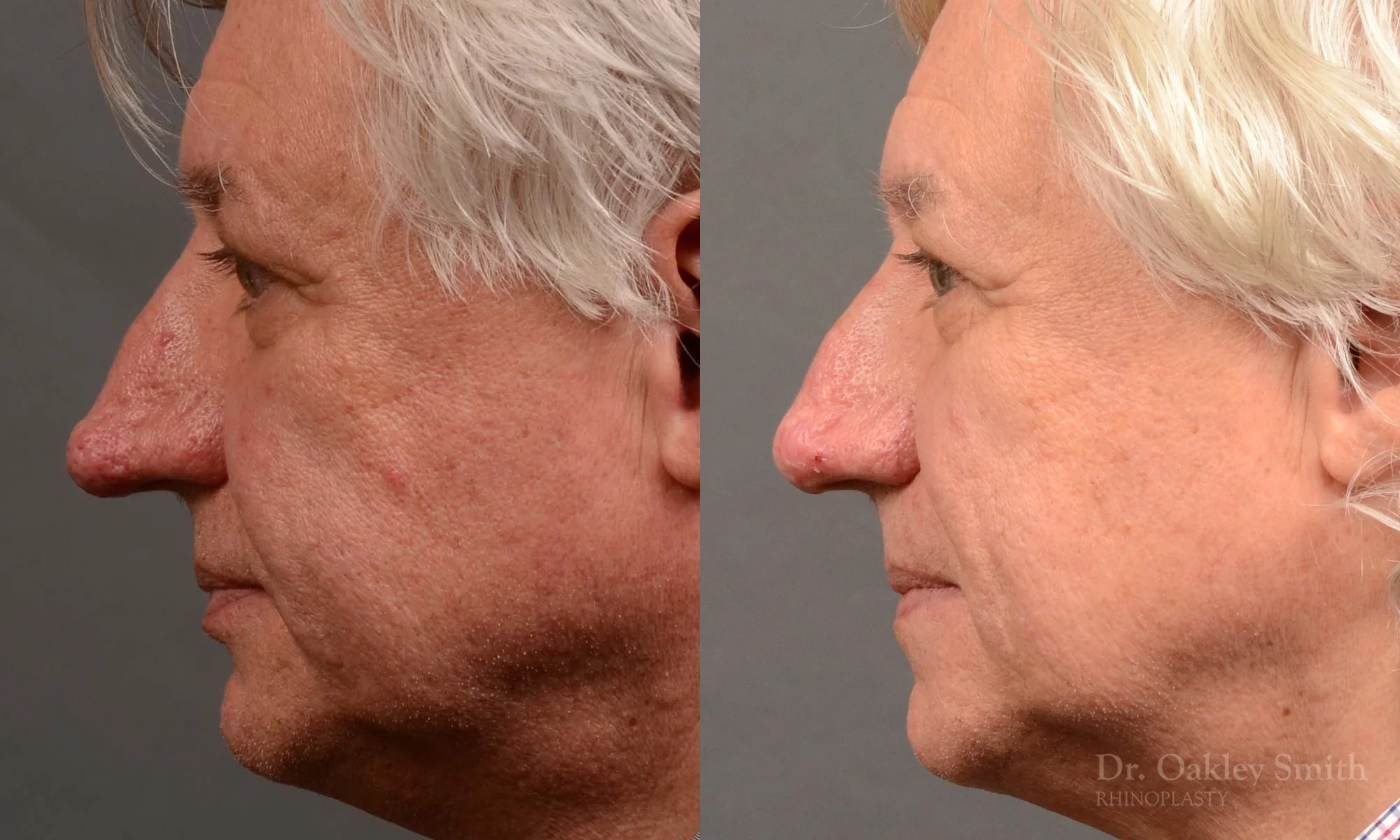 Case 532, Dr. Oakley Smith, rhinophyma, 12 months after surgery, left profile view