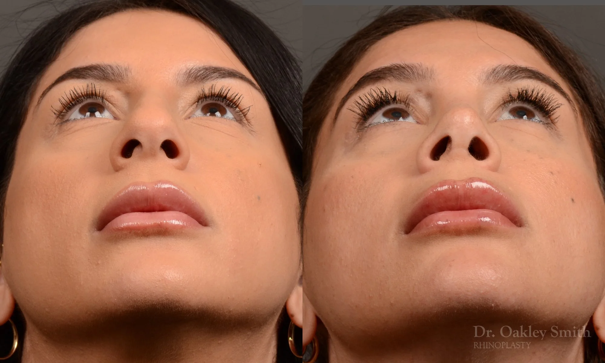 540F-rhinoplasty-dr-oakley-smith-toronto-nose-job.jpg