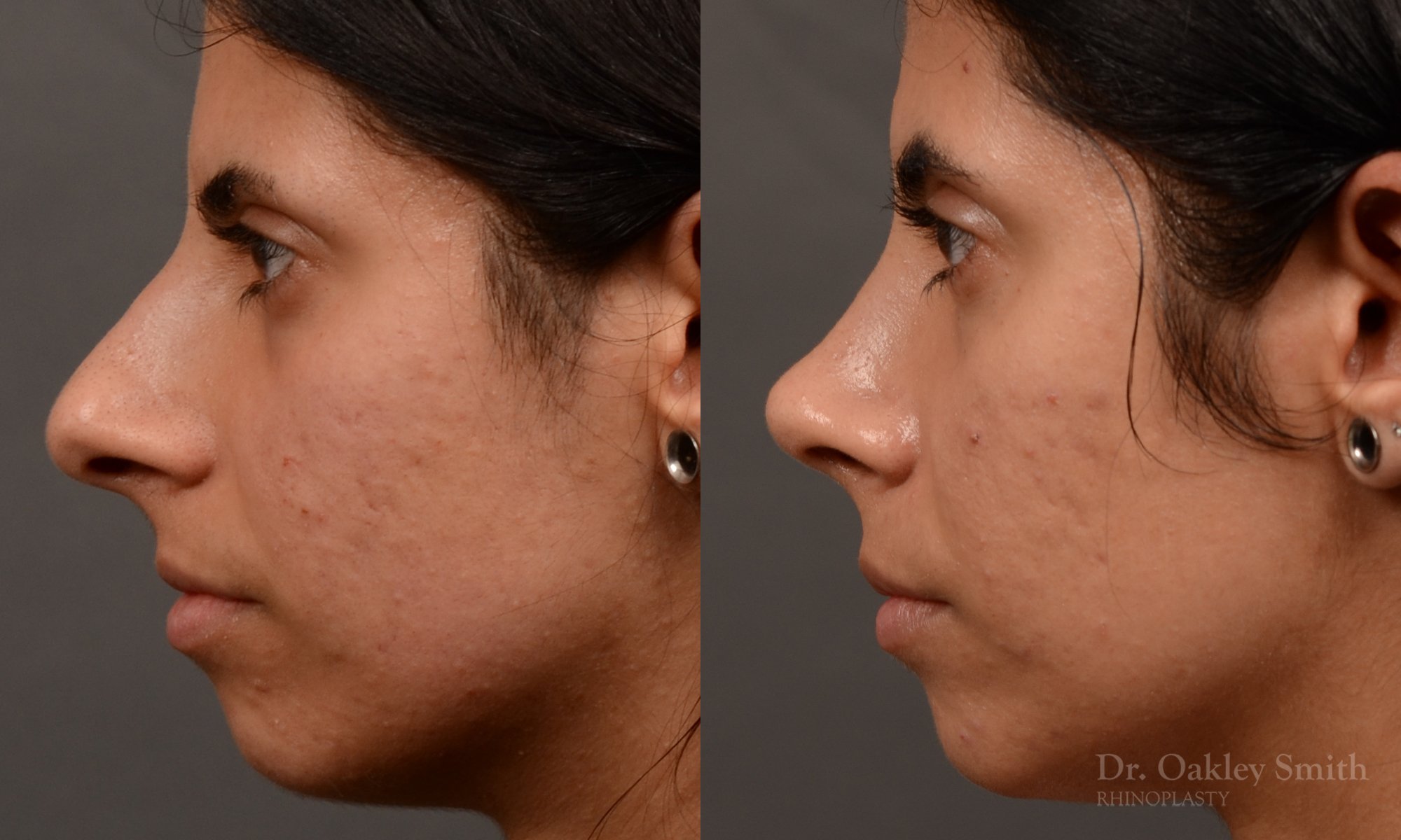 518E-rhinoplasty-dr-oakley-smith-toronto-top-surgeon-nose-job.jpg