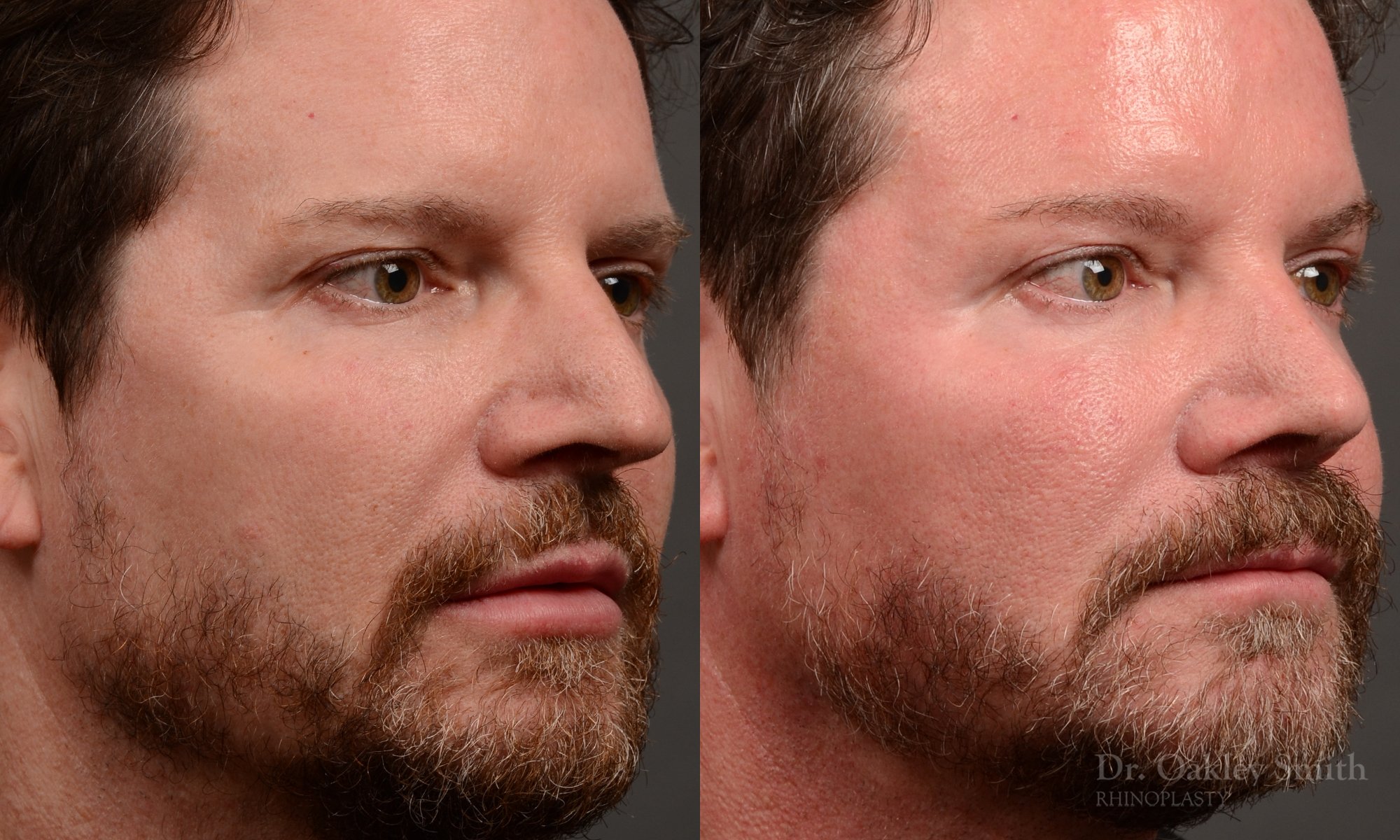 Case 560, Dr. Oakley Smith, male rhinoplasty, 12 months after surgery, right oblique view