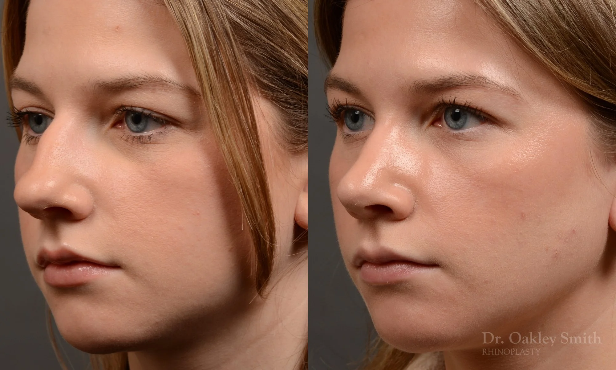 536D-rhinoplasty-dr.-oakley-smith-toronto-nose-job-best.jpg