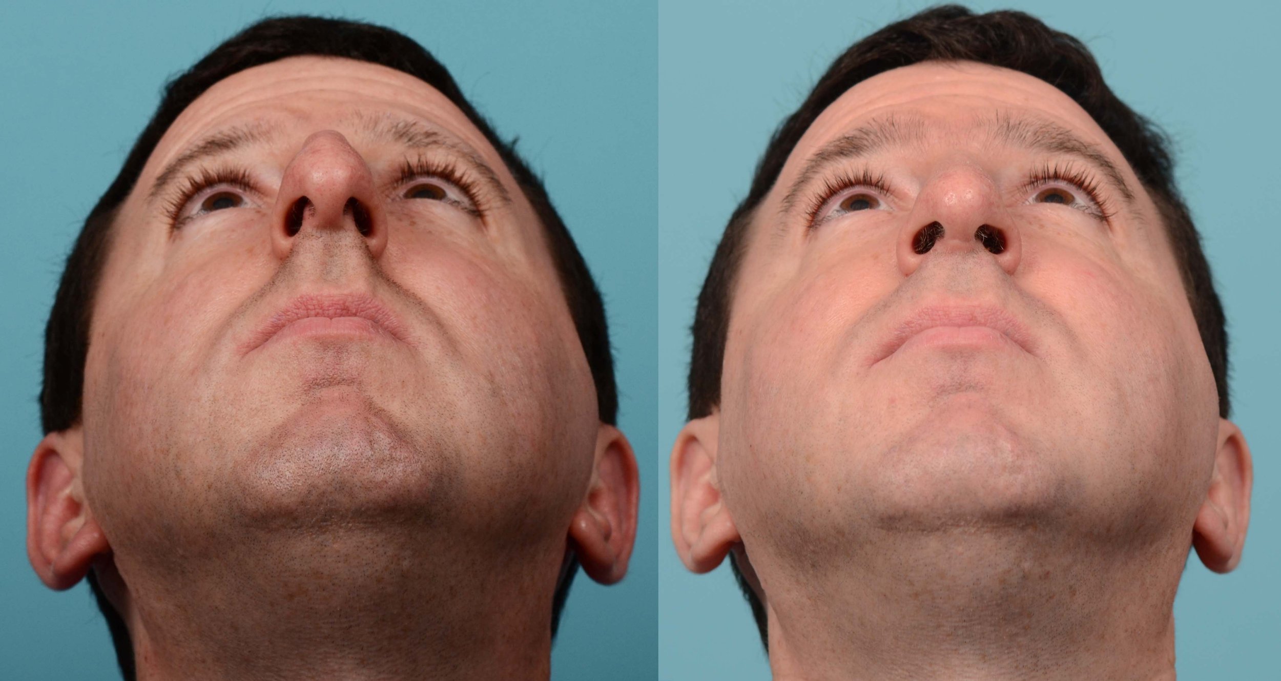 large-curved-male-nose-basal-view-before-after-1.jpg