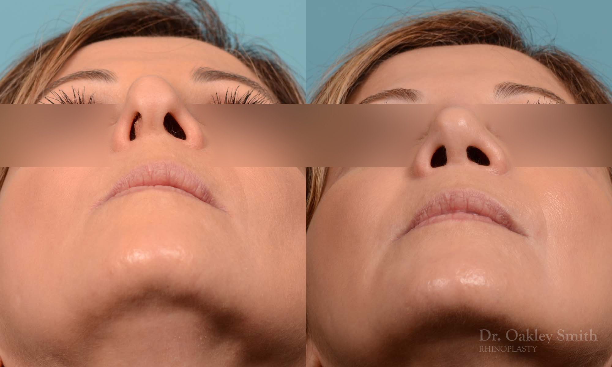 244F-rhinoplasty-dr-oakely-smith-septum (1).jpg