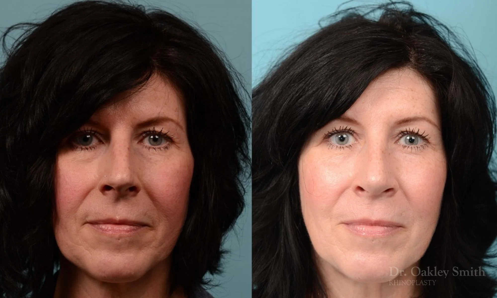 324A-rhinoplasty-dr-oakley-smith-toronto-nose-job.jpg