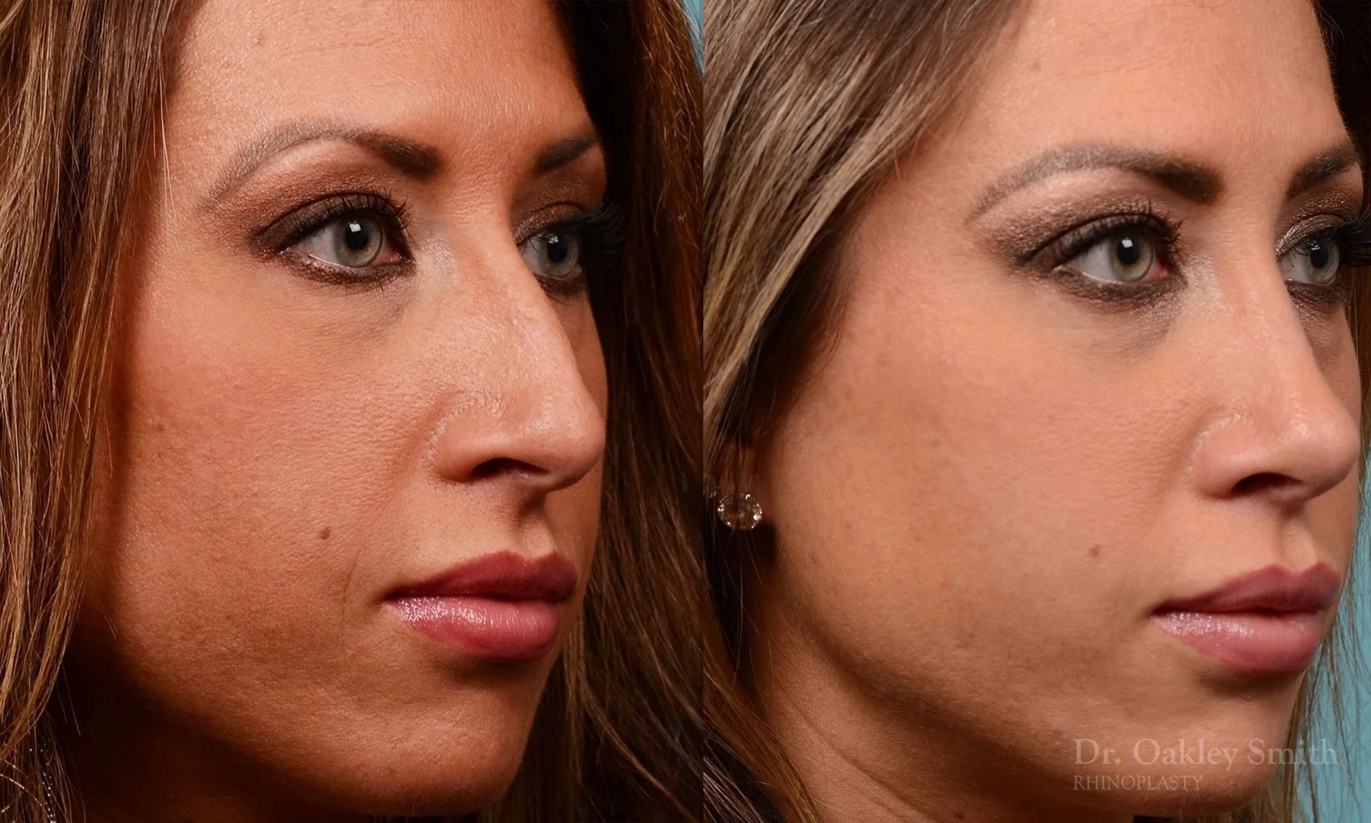 208B-watermark-rhinoplasty-toronto-dr-oakley-smith-female-nose-job-nose-job-big-nose-bump-bridge-1 (1).jpg