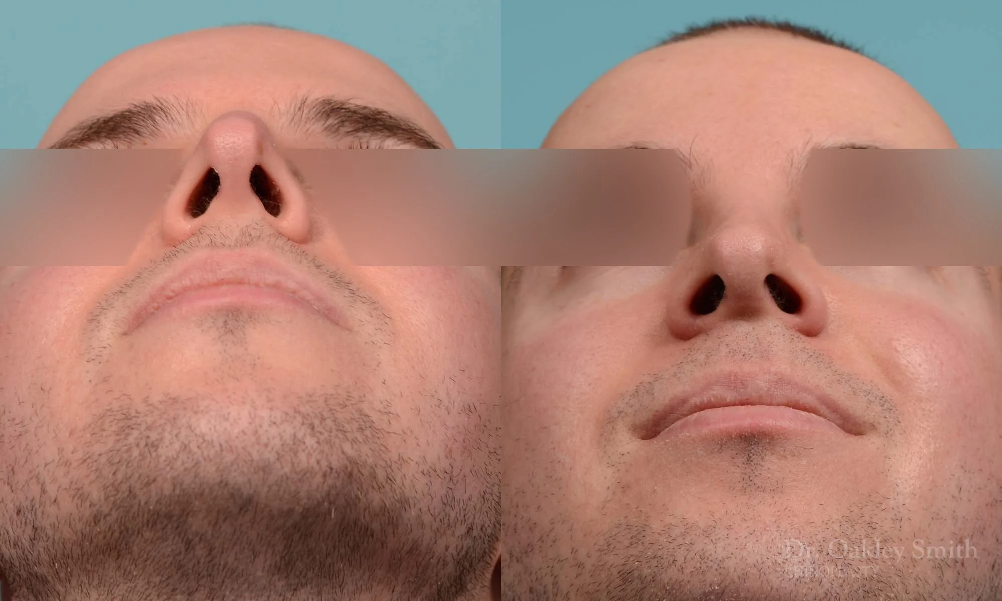 278F-rhinoplasty-dr-oakley-smith-toronto-male-nose-job.jpg