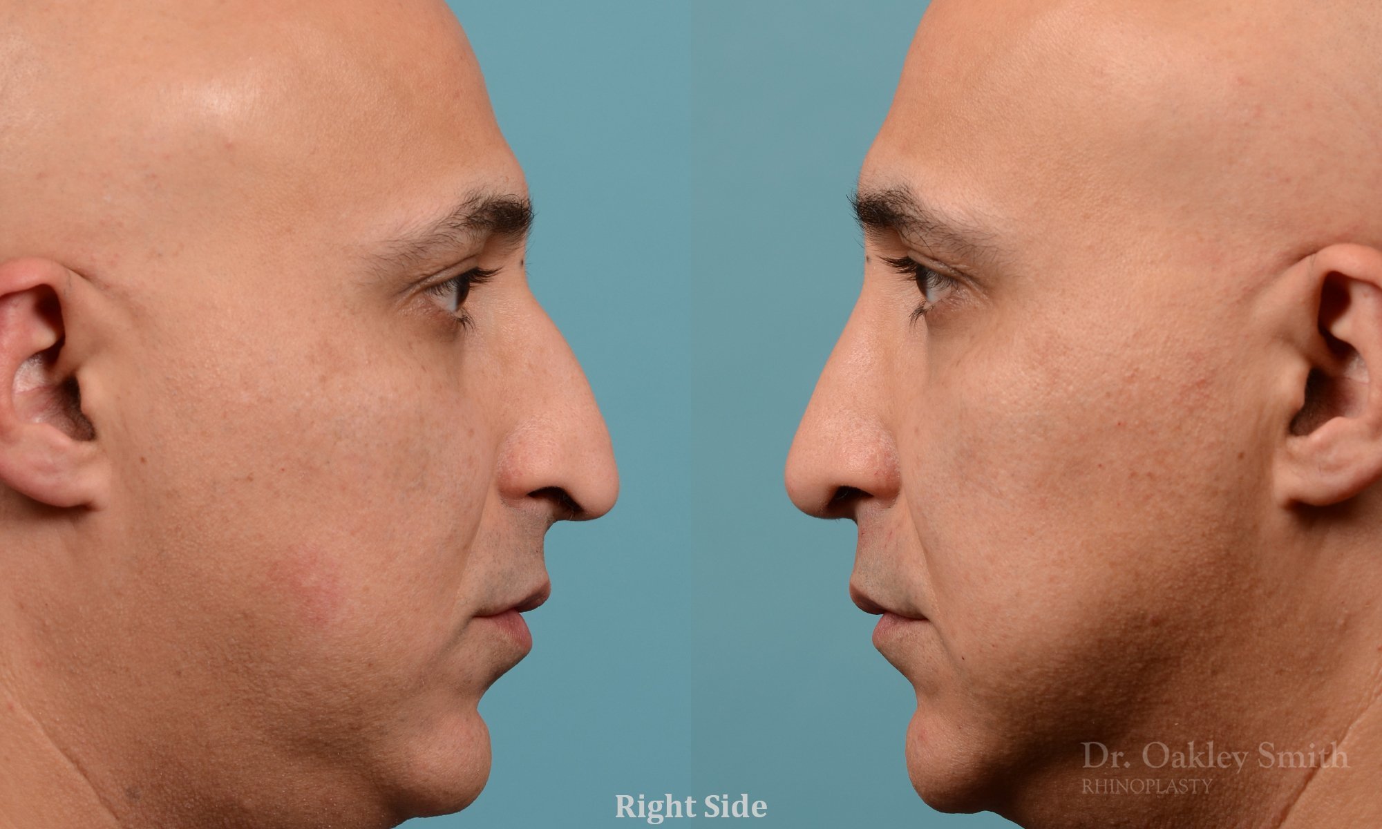 349: Primary Male Rhinoplasty, Normal Skin, Dorsal Hump, Droopy tip