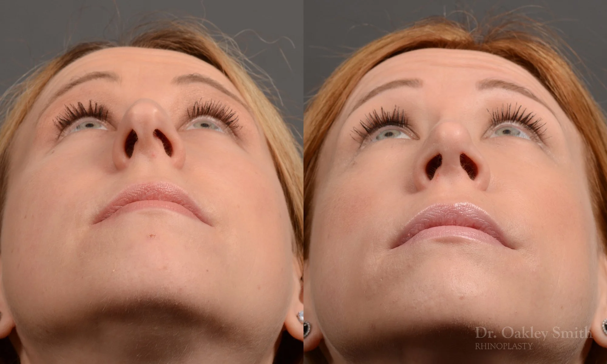 363.2F-rhinoplasty-dr-oakley-smith-toronto-nose-job.jpg