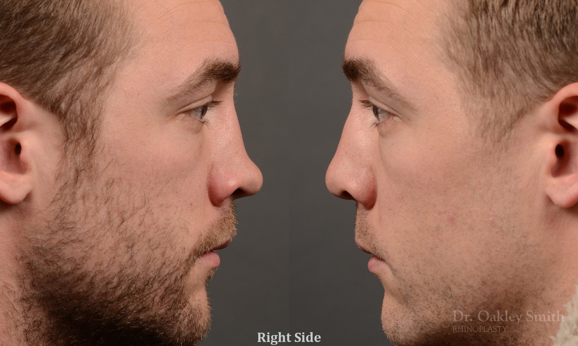 388C-rhinoplasty-dr-oakley-smith-toronto-nose-job.jpg