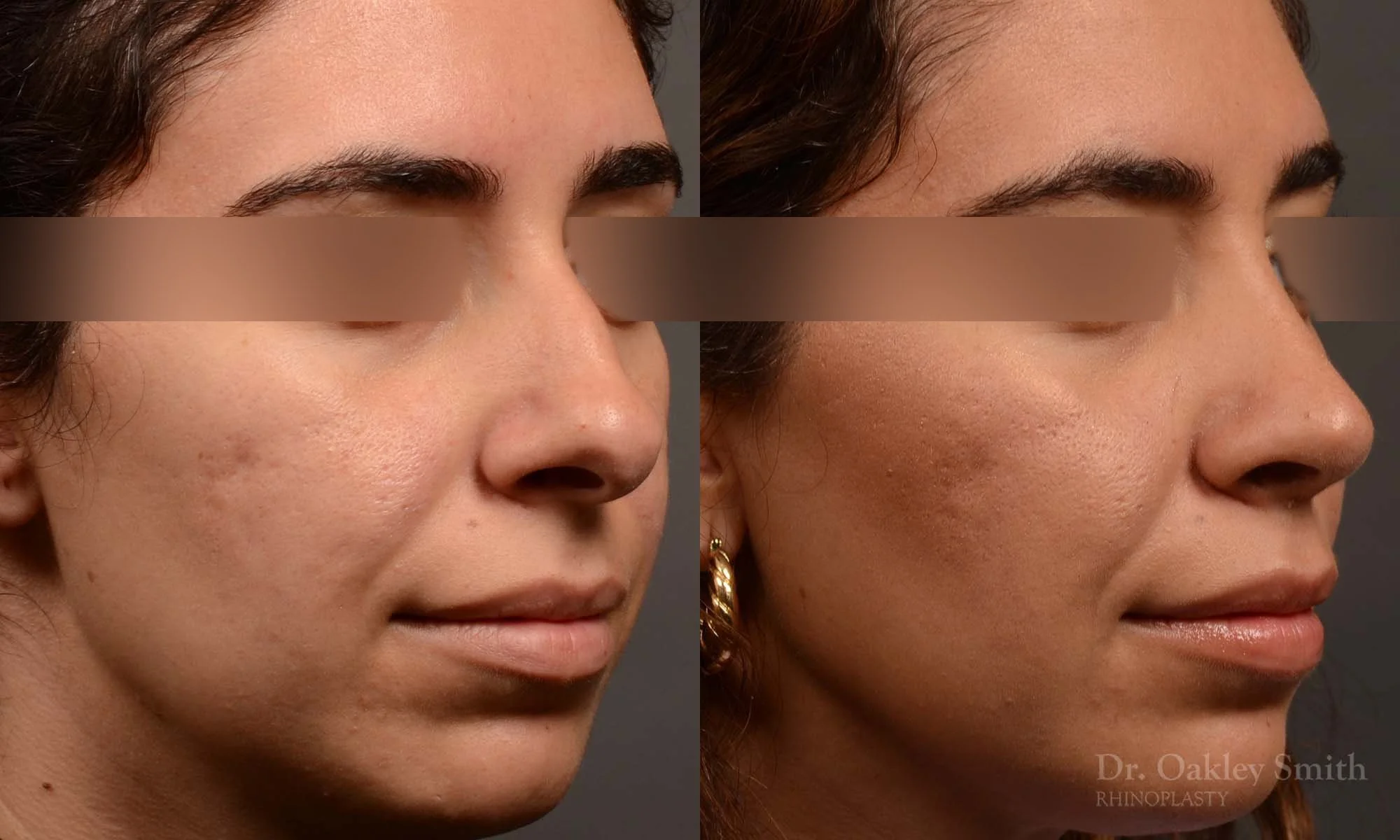 488B-rrhinoplasty-dr-oakley-smith-toronto-top-surgeon-nose-job.jpg