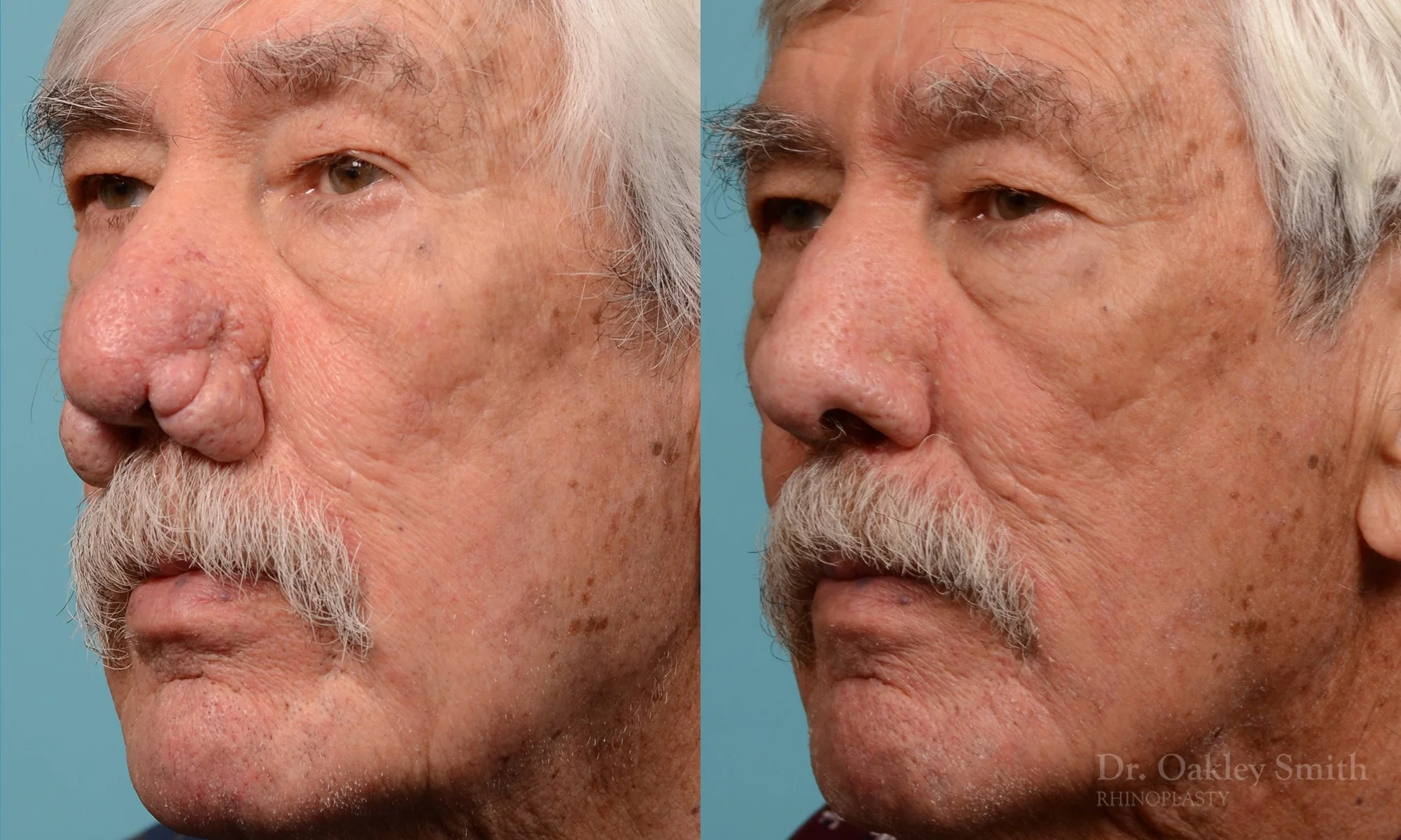 227D-rhinophyma-rhinoplasty-dr-oakley-smith-toronto-nose-job-1.jpg