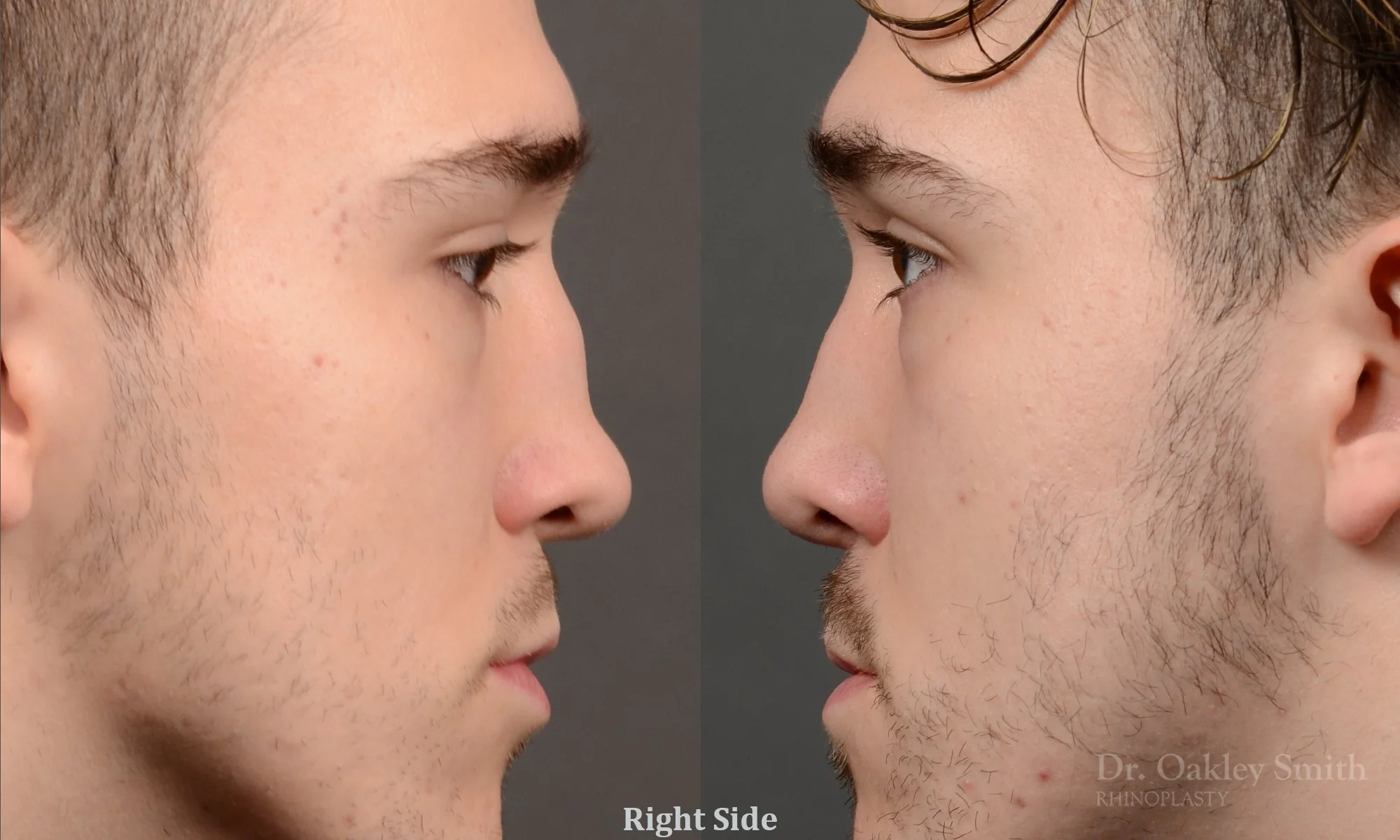 503: Primary Male Rhinoplasty, Normal Skin, Saddle Nose, Tip Work