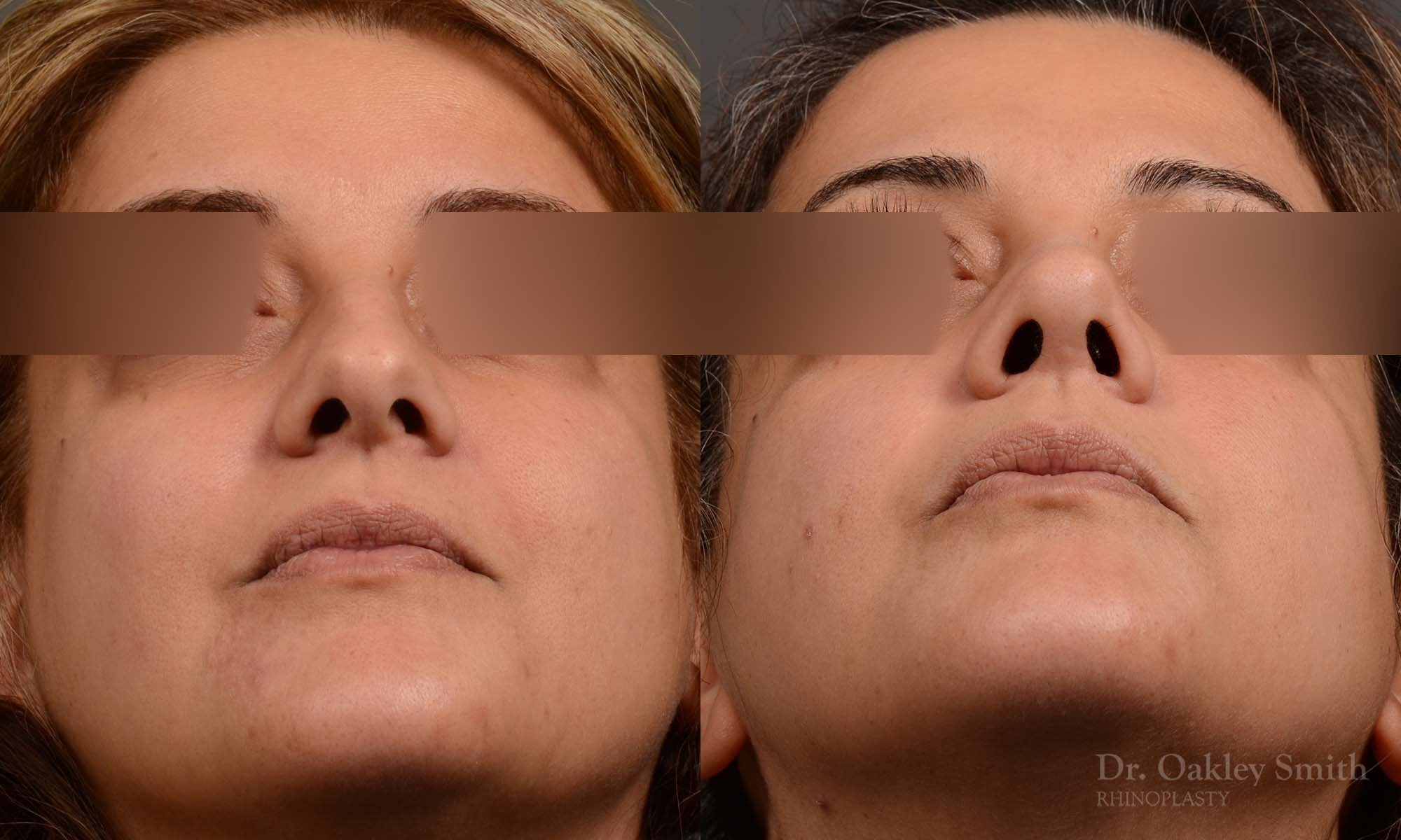 527F-rhinoplasty-dr-oakley-smith-toronto-top-surgeon-nose-job.jpg