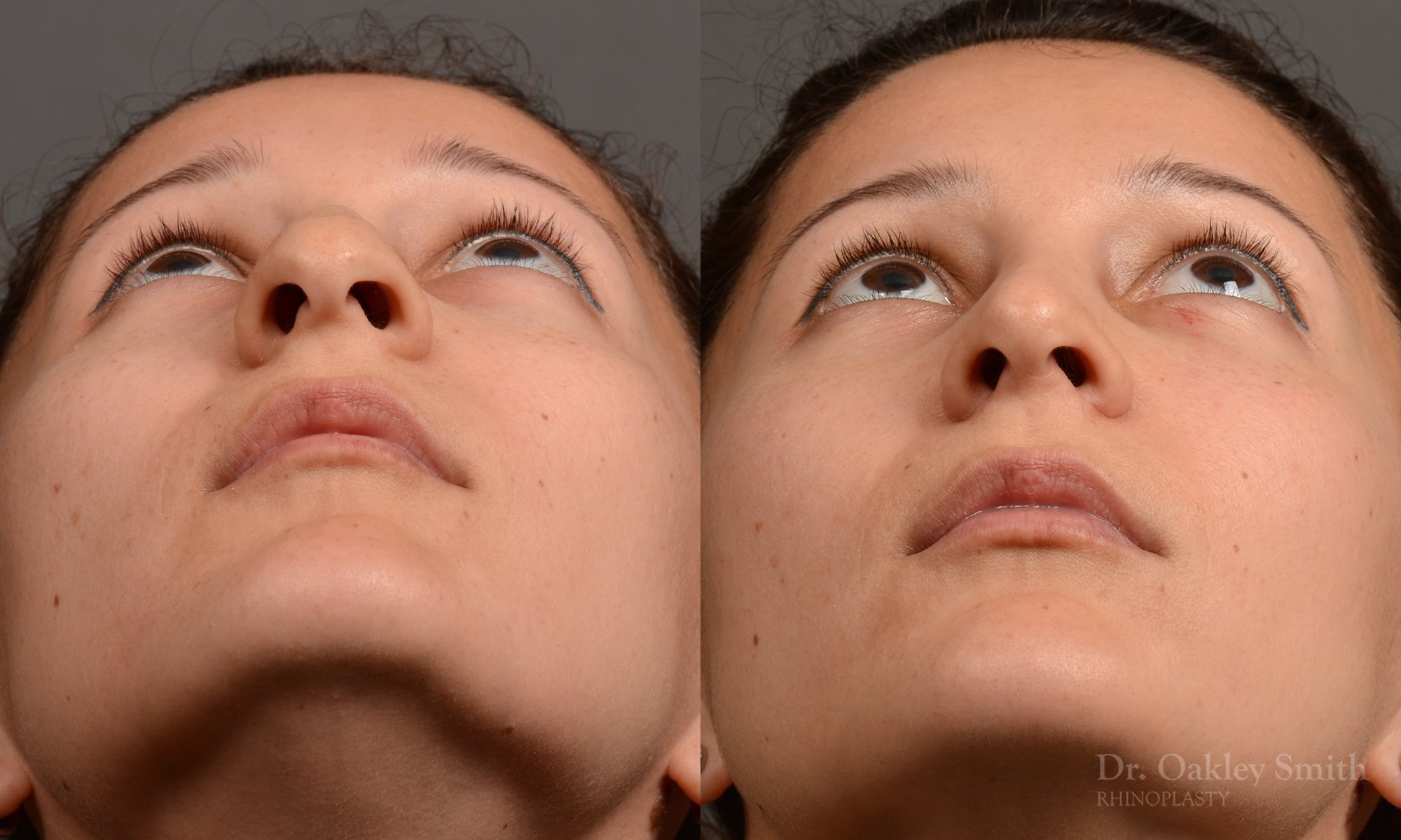 332F-rhinoplasty-dr-oakley-smith-toronto-nose-job.jpg
