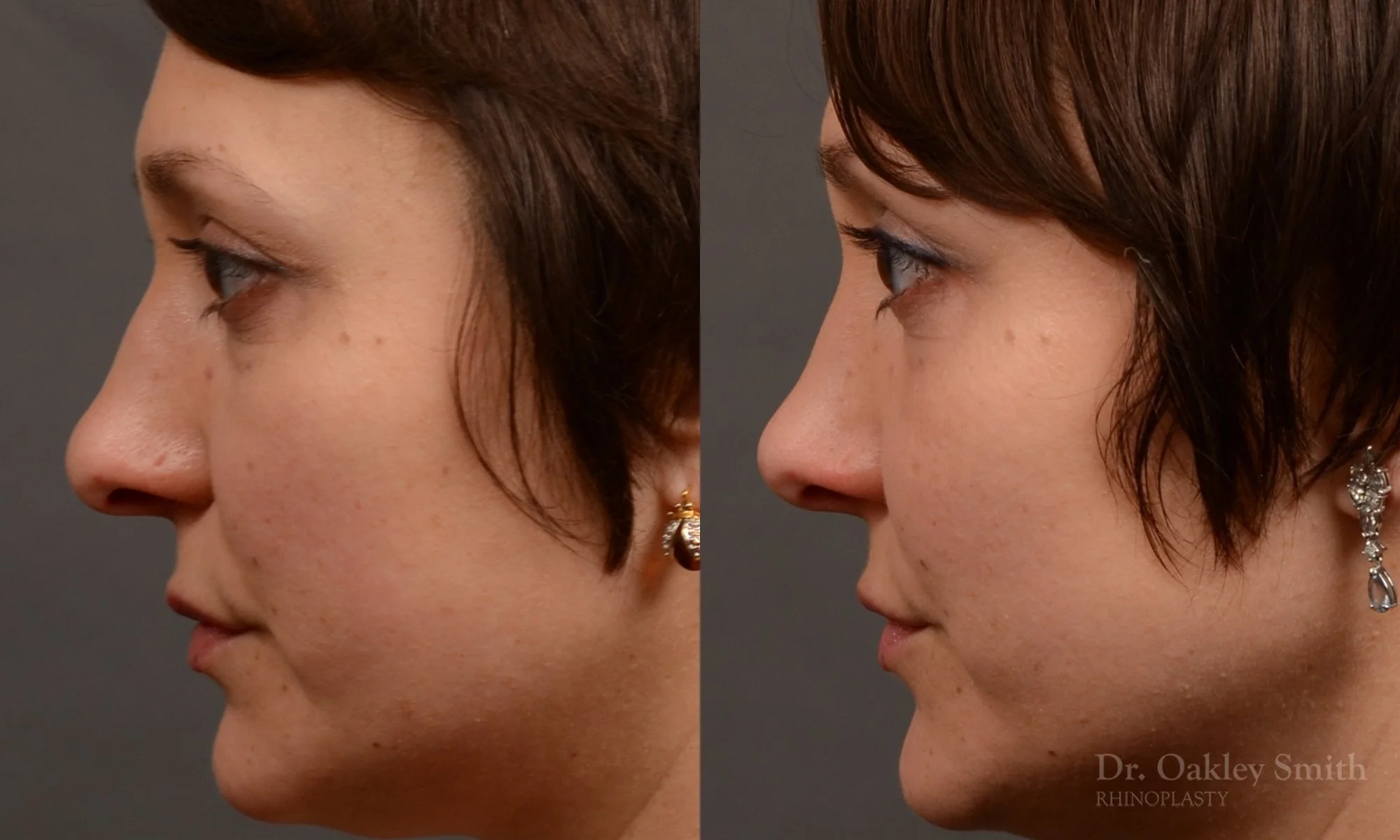 505D-rhinoplasty-dr-oakley-smith-toronto-top-surgeon-nose-job.jpg