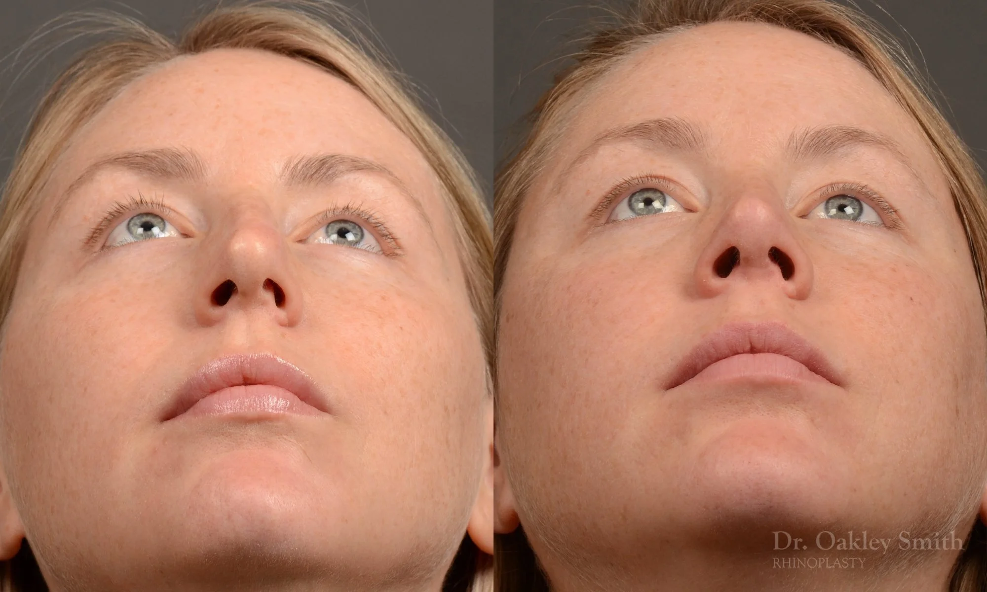 482F-rhinoplasty-dr-oakley-smith-toronto-top-surgeon-nose-job-1.jpg