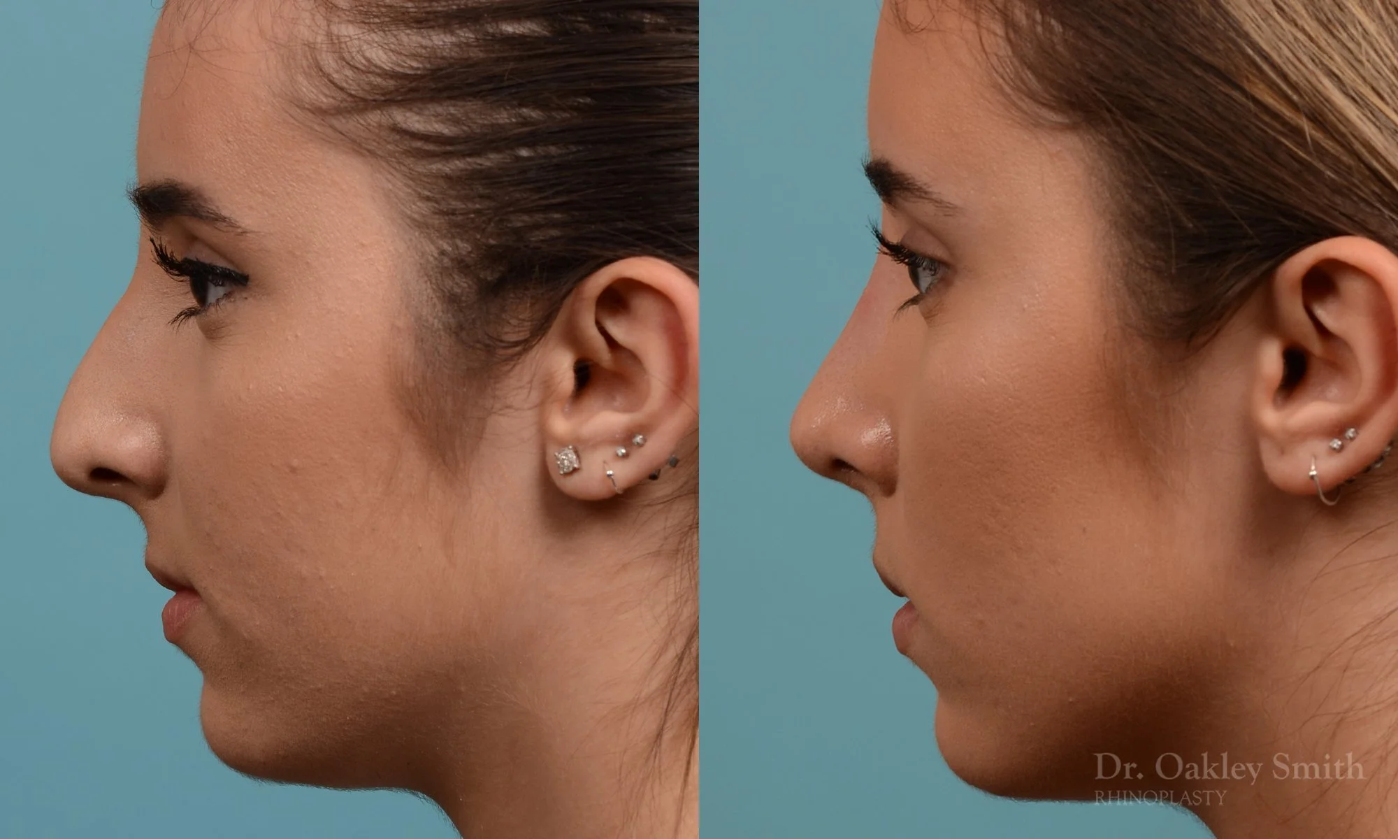 301E-rhinoplasty-dr-oakley-smith-toronto-nose-job.jpg