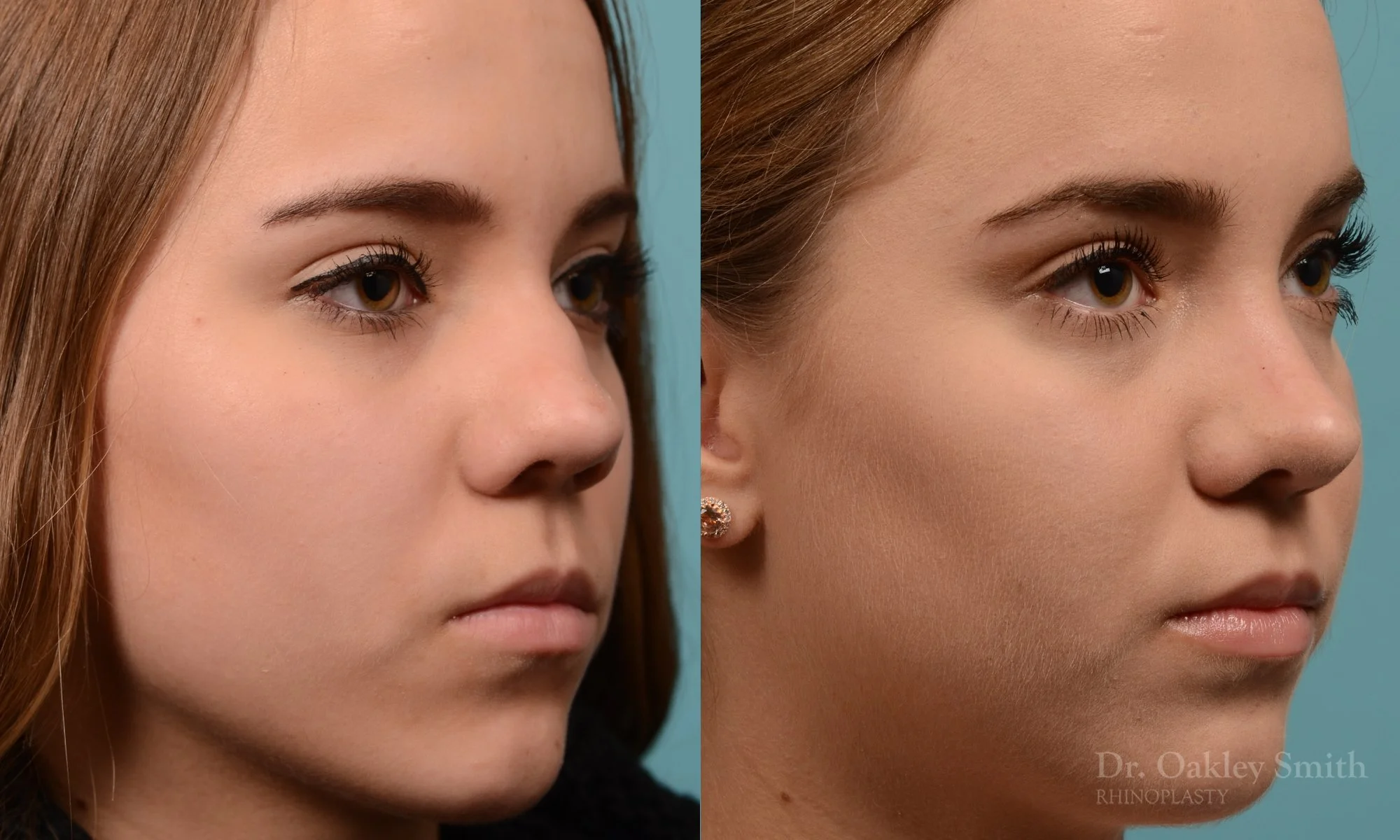 355B-rhinoplasty-dr-oakley-smith-toronto-nose-job.jpg